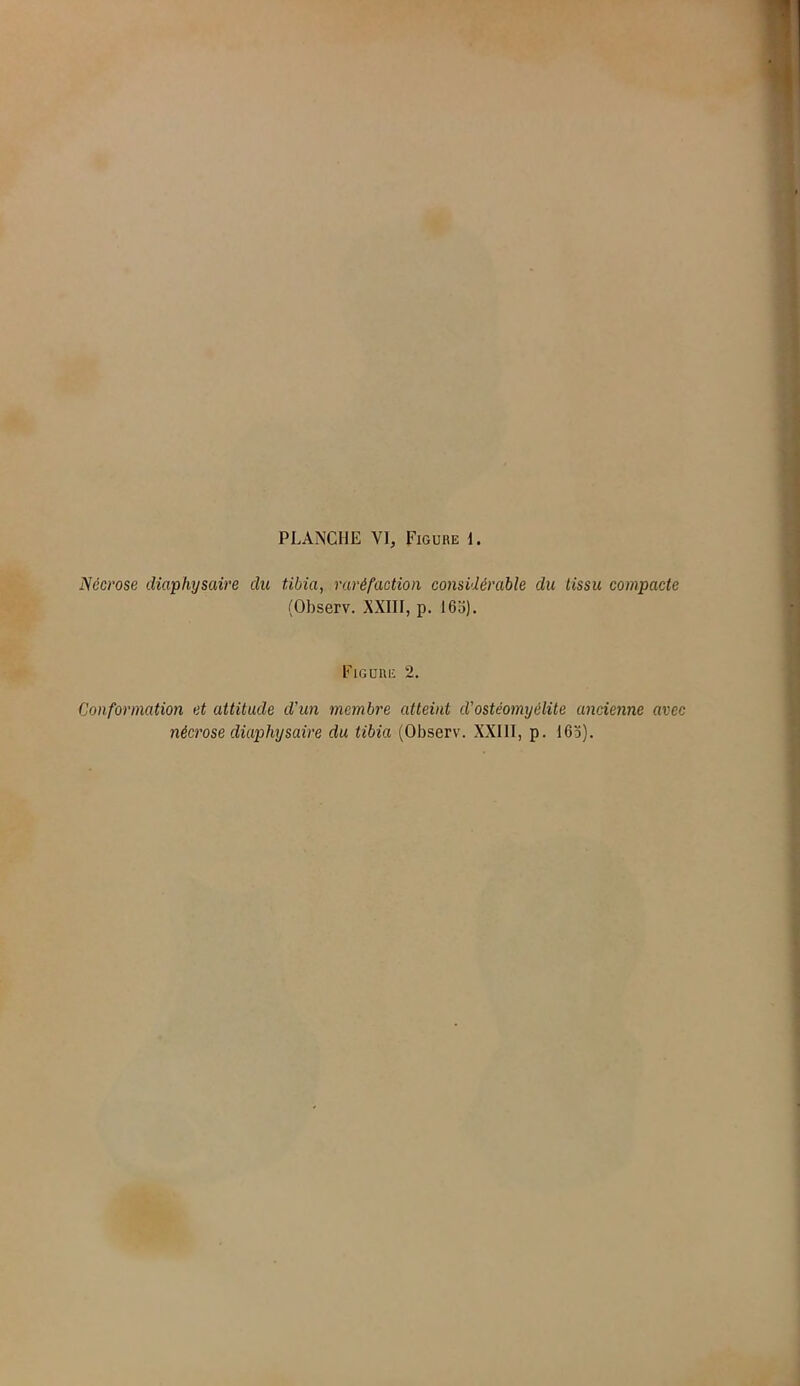 Nécrose diaphysaire du tibia, raréfaction considérable du tissu compacte (Observ. XXIII, p. 165). Figure 2. Conformation et attitude d'un membre atteint d'ostéomyélite ancienne avec nécrose diaphysaire du tibia (Observ. XXIII, p. 163).