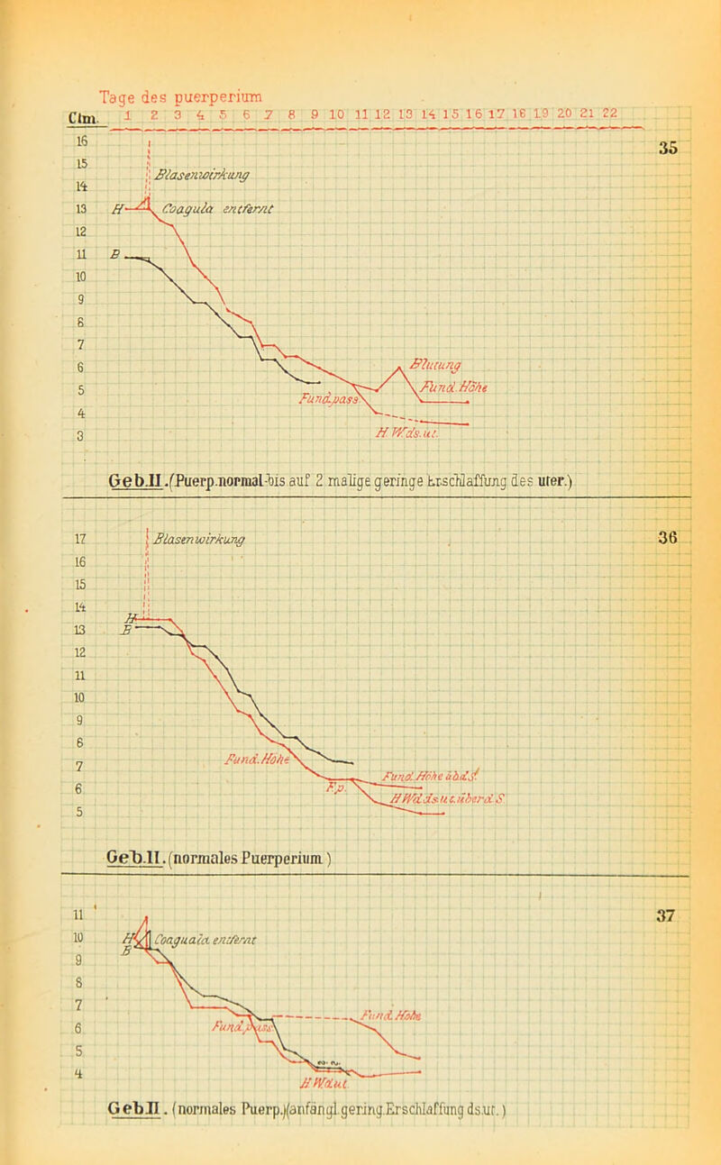 Ctrn. 1 2 3 ^ * 5 6 7 e 9 10 11 12 13 15 16 17 16 19 20 21 22 BlasenioerAung 13 Coagula emferne 12 17 16 15 11 13 12 11 10 9 6 7 6 5 Blutung FundBohe H.Wds.ut. Geb.11 /Puerp.nopmal-Qis auf 2 malige geringe krsÖüaffimg des urer.) j Blasen wirkung Bund. Hohe Bund, flehe ühd.'l fl Hhids. u c. überd S 35 36 Ge~b.ll. (normales Puerperium) 11 io 9 8 7 6 5 ‘i 37 G eb JI. (normales Puerp.)(anfangl.gering.ErschIaffung ds.ur.)