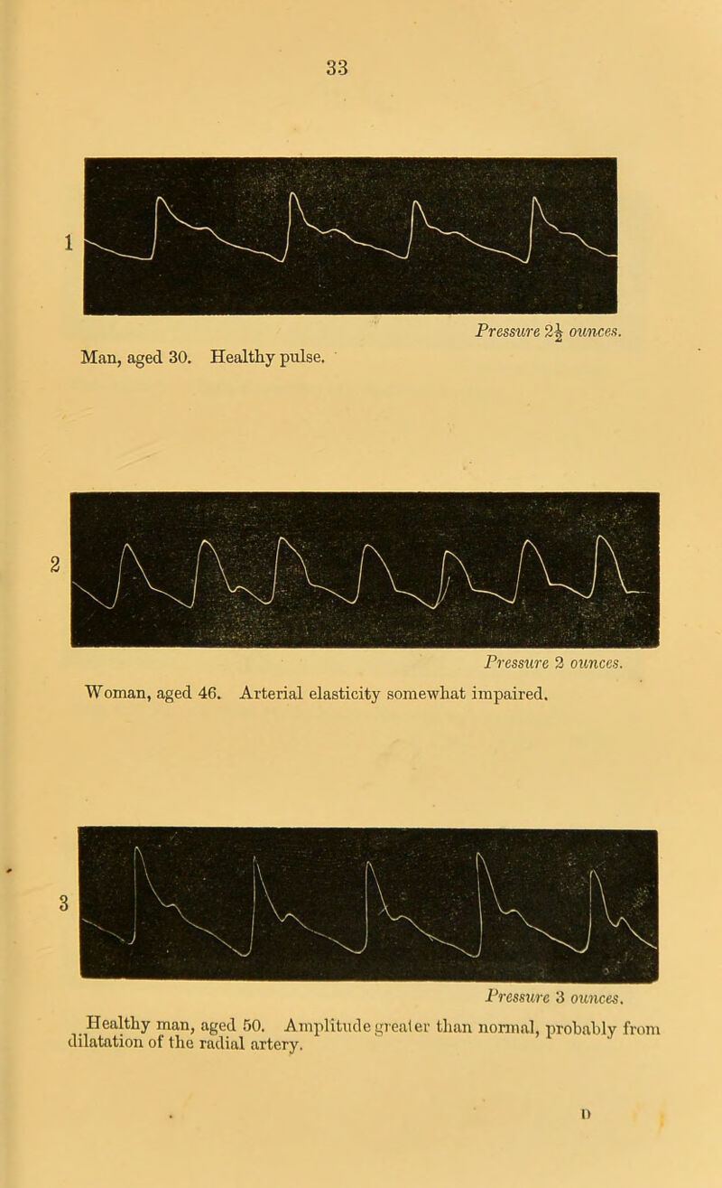 Pressure 2 ounces. Woman, aged 46. Arterial elasticity somewhat impaired. Pressure 3 ounces. Healthy man, aged 60. Amplitude greater than normal, probably from dilatation of the radial artery. it