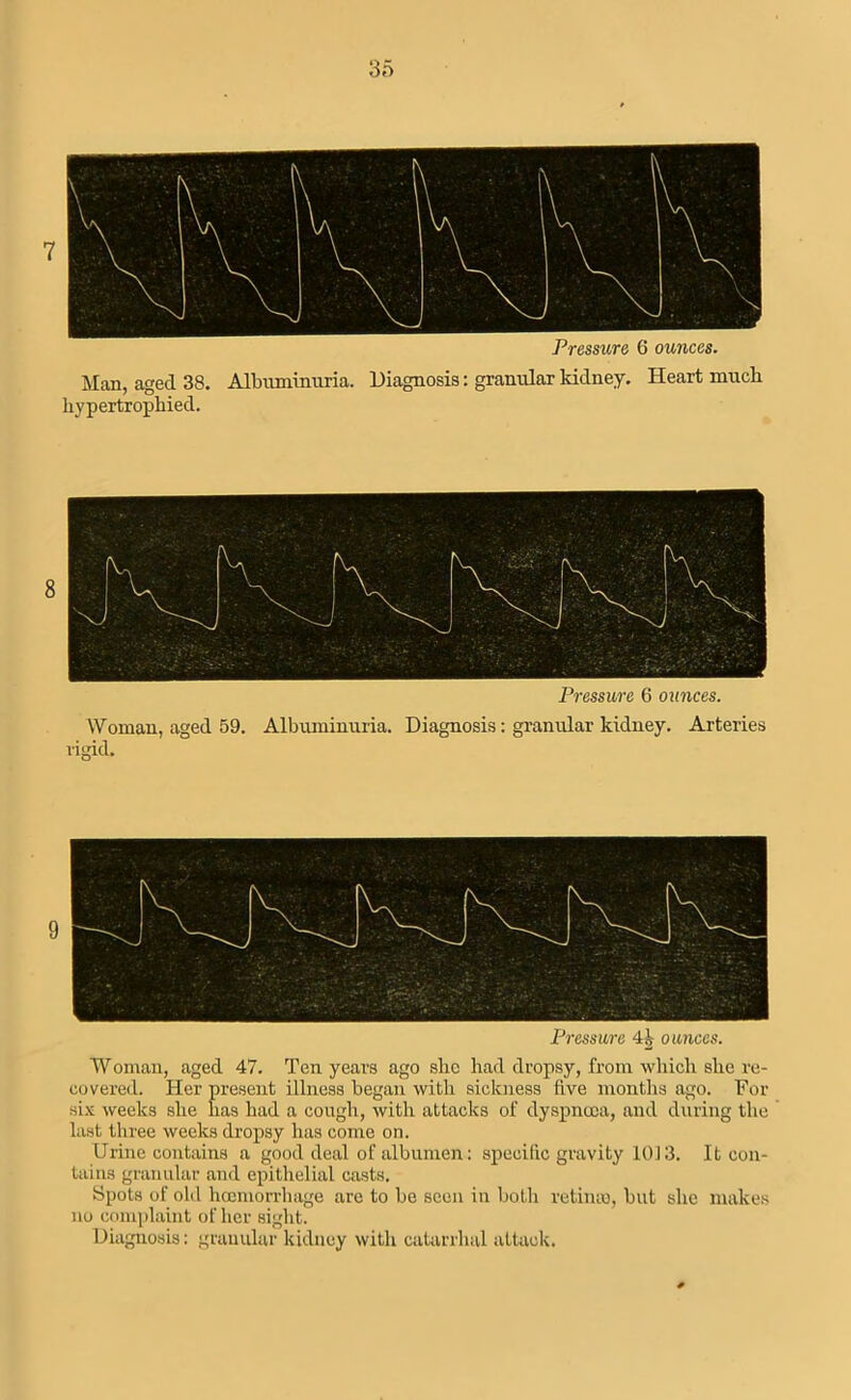Pressure 6 ounces. Man, aged 38. Albuminuria. Diagnosis: granular kidney. Heart much hypertrophied. Pressure 6 ounces. Woman, aged 59. Albuminuria. Diagnosis: granular kidney. Arteries rigid. Pressure 4| ounces. Woman, aged 47. Ten years ago she had dropsy, from which she re- covered. Her present illness began with sickness five months ago. For six weeks she has had a cough, with attacks of dyspnoea, and during the last three weeks dropsy has come on. Urine contains a good deal of albumen: specific gravity 1013. It con- tains granular and epithelial casts. Spots of old haemorrhage are to be seen in both retime, but she makes no complaint of her sight. Diagnosis: granular kidney with catarrhal attack.
