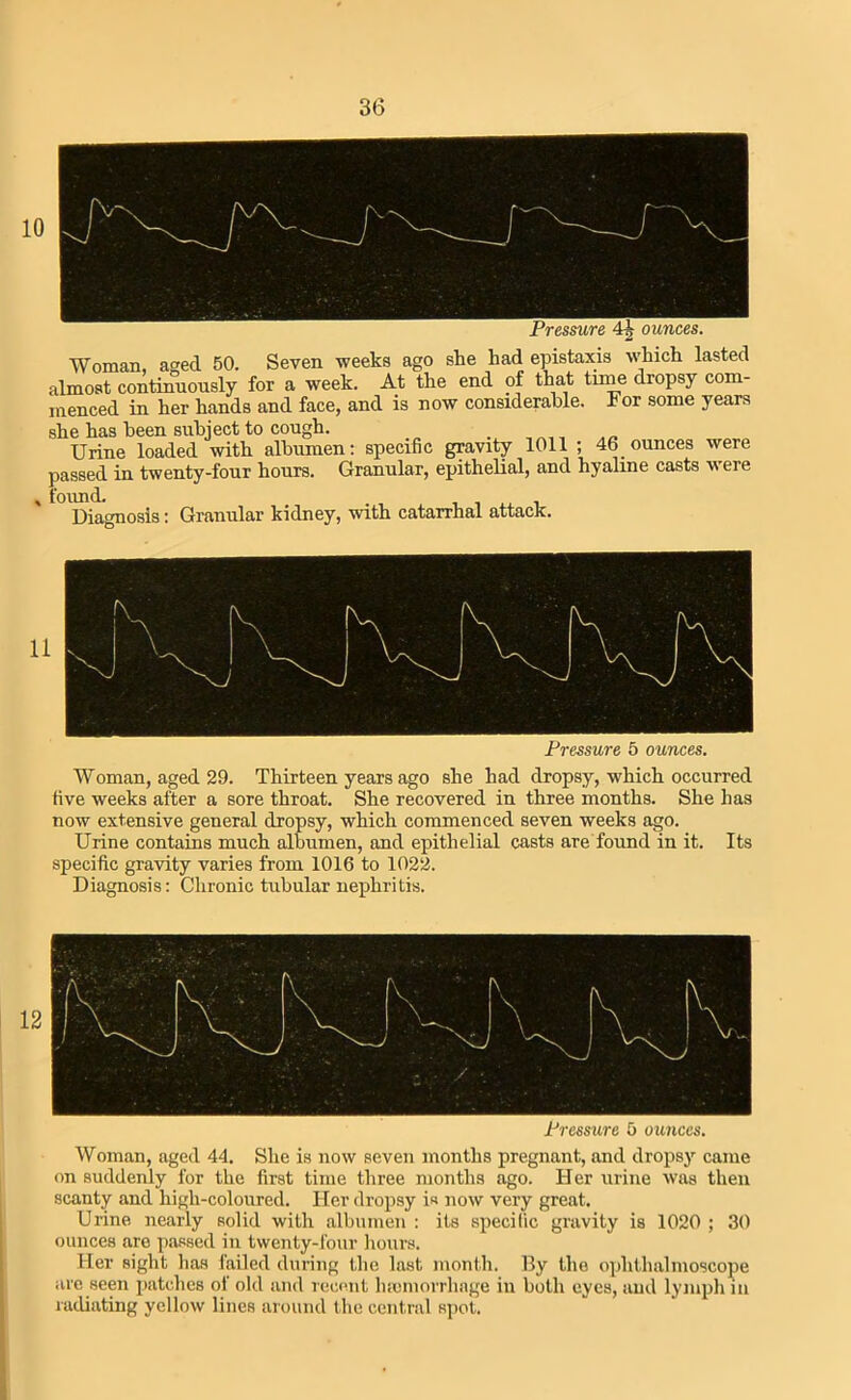 36 10 Woman, aged 50. Seven weeks ago she had epistaxis which lasted almost continuously for a week. At the end of that time dropsy com- menced in her hands and face, and is now considerable. For some years she has been subject to cough. Urine loaded with albumen: specific gravity 1011 ; 46 ounces were passed in twenty-four hours. Granular, epithelial, and hyaline casts were found. Diagnosis: Granular kidney, with catarrhal attack. Pressure 5 ounces. Woman, aged 29. Thirteen years ago she had dropsy, which occurred five weeks after a sore throat. She recovered in three months. She has now extensive general dropsy, which commenced seven weeks ago. Urine contains much albumen, and epithelial casts are found in it. Its specific gravity varies from 1016 to 1022. Diagnosis: Chronic tubular nephritis. Pressure 5 ounces. Woman, aged 44. She is now seven months pregnant, and dropsy came on suddenly for the first time three months ago. Her urine was then scanty and high-coloured. Her dropsy is now very great. Urine nearly solid with albumen : its specific gravity is 1020 ; 30 ounces are passed in twenty-four hours. Her sight has failed during the last month. By the ophthalmoscope are seen patches of old and recent hmmorrhage in both eyes, and lymph in radiating yellow lines around the central spot.