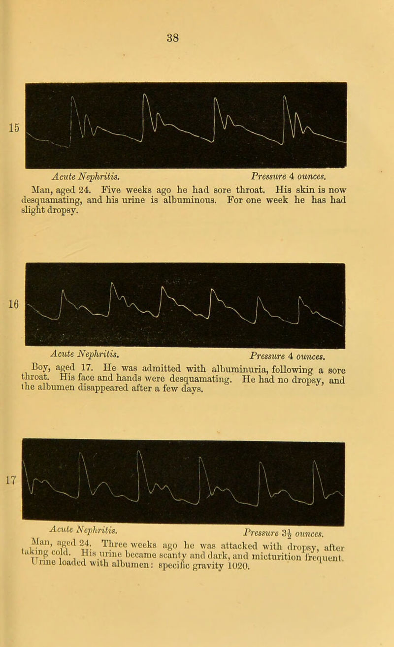 38 15 Acute Nephritis. Pressure 4 ounces. Man, aged 24. Five weeks ago he had sore throat. His skin is now desquamating, and his urine is albuminous. For one week he has had slight dropsy. Acute Nephritis. Pressure 4 ounces. B°y, ane_d 17. He was admitted with albuminuria, following a sore throat. His face and hands were desquamating. He had no dropsy, and the albumen disappeared after a few days. Acute Nephritis. Pressure ounces. Man, aged 24. Three weeks ago he was attacked with dropsy, after ‘ TTri’no l ' i ?1B-luiniei becanie Bcan,y dark, and micturition frequent. Unne loaded with albumen: specific gravity 1020.