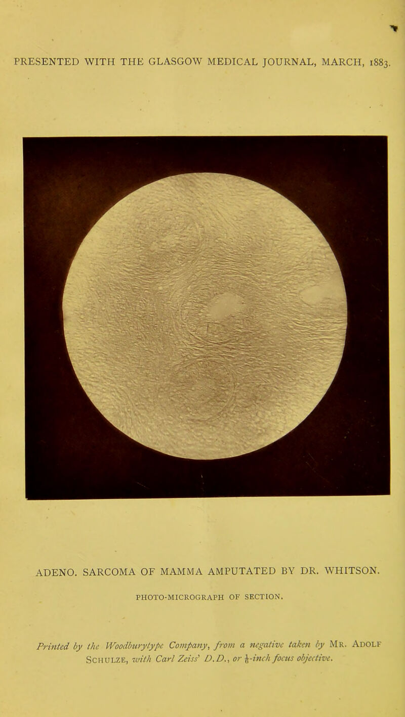 PRESENTED WITH THE GLASGOW MEDICAL JOURNAL, MARCH, 1883 ADENO. SARCOMA OF MAMMA AMPUTATED BY DR. WHITSON. PHOTO-MICROGRAPH OF SECTION. Printed by the Woodburytype Company, from a negative taken by Mr. Adolf Schulze, with Carl Zeiss' D.D., or \-inch focus objective.