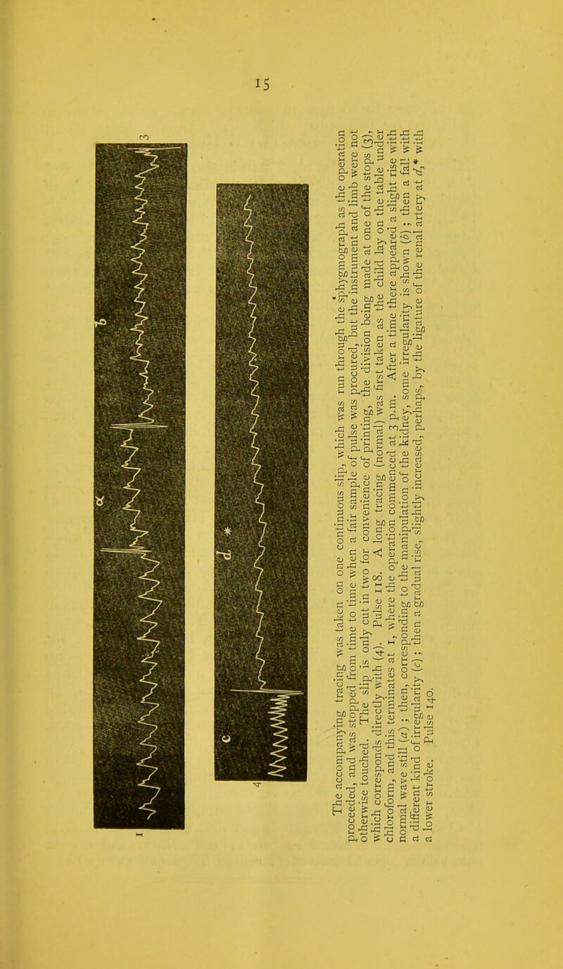 a lower stroke. Pulse 140.