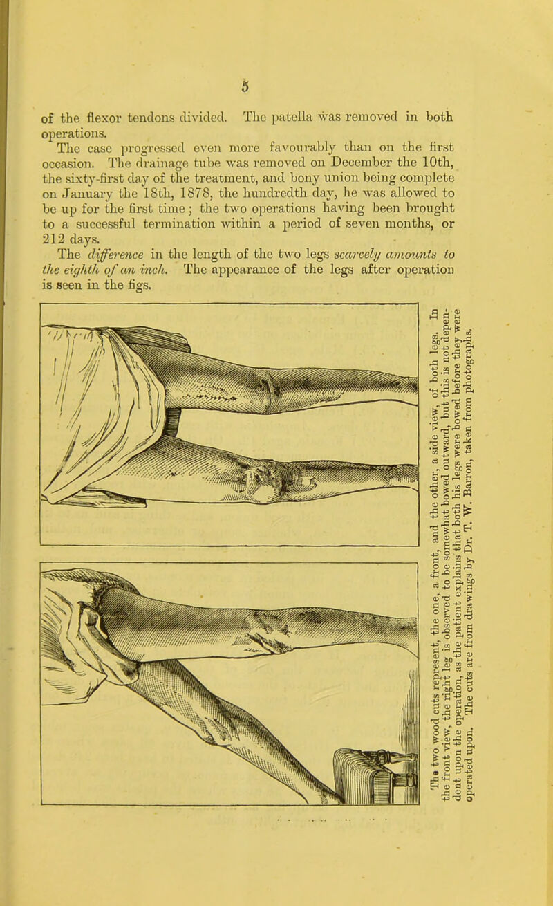 of the flexor tendons divided. The patella was removed in both operations. The case progressed even more favourably than on the first occasion. The drainage tube was removed on December the 10th, the sixty-first day of the treatment, and bony union being complete on January the 18th, 1878, the hundredth day, he was allowed to be up for the first time; the two operations having been brought to a successful termination within a period of seven months, or 212 days. The difference in the length of the two legs scarcely amounts to the eighth of an inch,. The appearance of the legs after operation is seen in the figs.