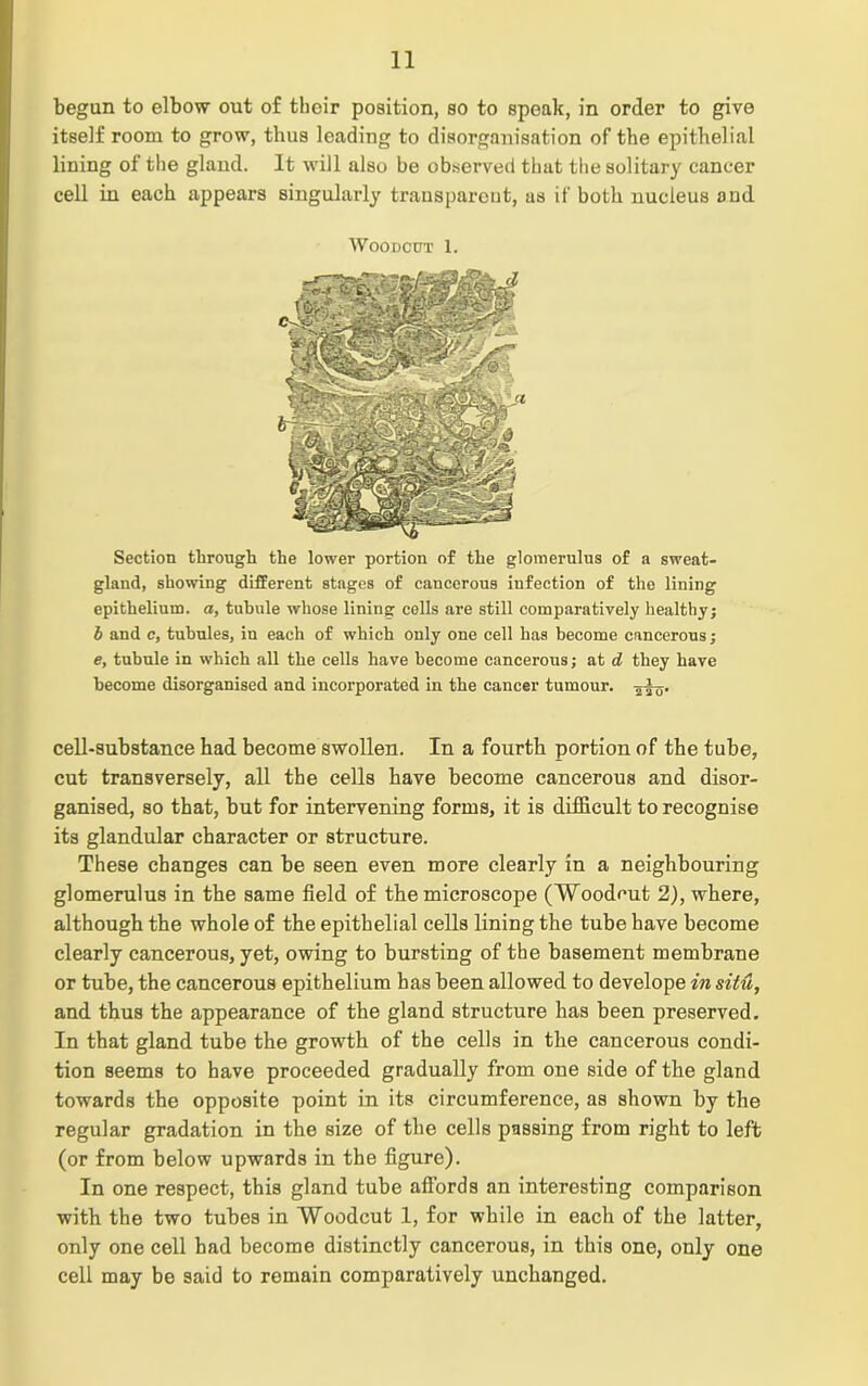 begun to elbow out of thoir position, so to speak, in order to give itself room to grow, thus loading to disorganisation of the epithelial lining of the gland. It will also be observed that the solitary cancer cell in each appears singularly transparent, as if both nucleus and Woodcut 1. Section through the lower portion of the glomerulus of a sweat- gland, showing different stages of cancerous infection of the lining epithelium, a, tubule whose lining cells are still comparatively healthy j b and c, tubules, in each of which only one cell has become cancerous; e, tubule in which all the cells have become cancerous; at d they have become disorganised and incorporated in the cancer tumour, cell-substance had become swollen. In a fourth portion of the tube, cut transversely, all the cells have become cancerous and disor- ganised, so that, but for intervening forms, it is difficult to recognise its glandular character or structure. These changes can be seen even more clearly in a neighbouring glomerulus in the same field of the microscope (Woodcut 2), where, although the whole of the epithelial cells lining the tube have become clearly cancerous, yet, owing to bursting of the basement membrane or tube, the cancerous epithelium has been allowed to develope in situ, and thus the appearance of the gland structure has been preserved. In that gland tube the growth of the cells in the cancerous condi- tion seems to have proceeded gradually from one side of the gland towards the opposite point in its circumference, as shown by the regular gradation in the size of the cells passing from right to left (or from below upwards in the figure). In one respect, this gland tube affords an interesting comparison with the two tubes in Woodcut 1, for while in each of the latter, only one cell had become distinctly cancerous, in this one, only one cell may be said to remain comparatively unchanged.