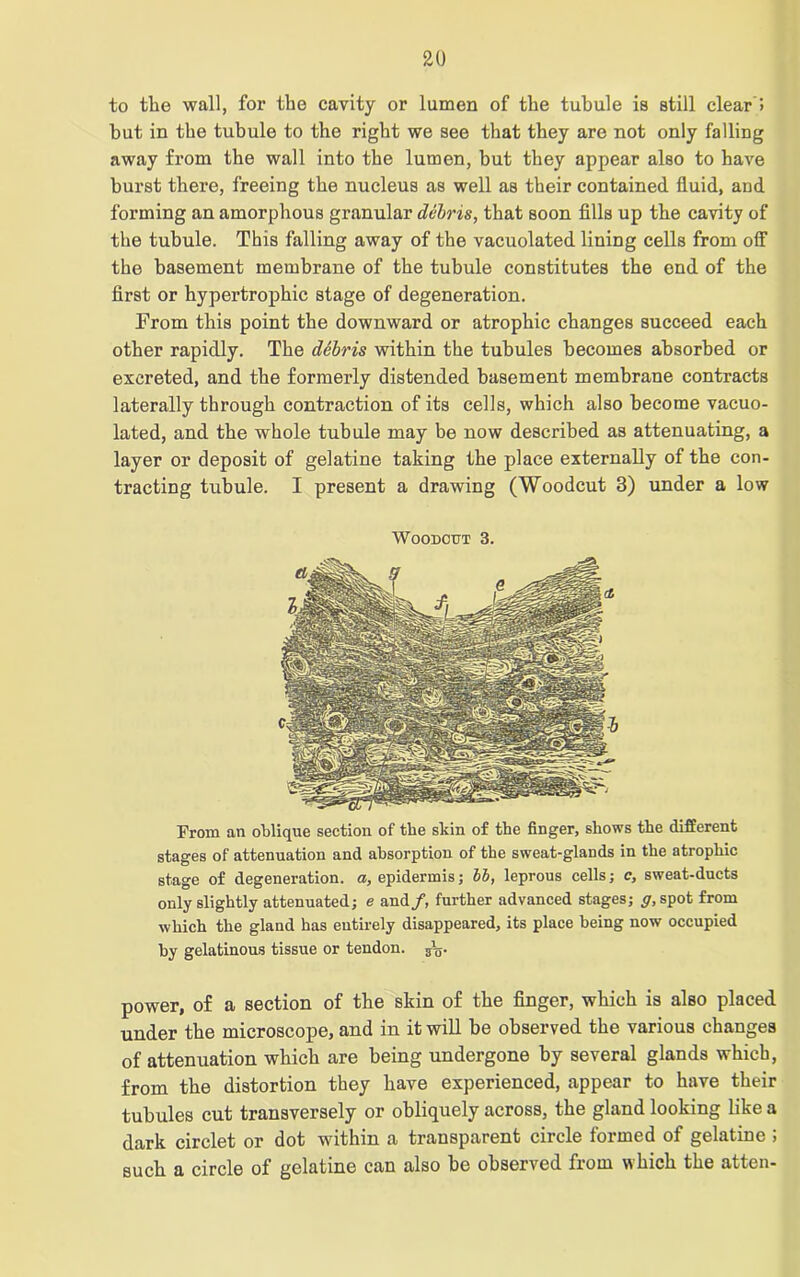 but in the tubule to the right we see that they are not only falling away from the wall into the lumen, but they appear also to have burst there, freeing the nucleus as well as their contained fluid, and forming an amorphous granular debris, that soon fills up the cavity of the tubule. This falling away of the vacuolated lining cells from off the basement membrane of the tubule constitutes the end of the first or hypertrophic stage of degeneration. From this point the downward or atrophic changes succeed each other rapidly. The debris within the tubules becomes absorbed or excreted, and the formerly distended basement membrane contracts laterally through contraction of its cells, which also become vacuo- lated, and the whole tubule may be now described as attenuating, a layer or deposit of gelatine taking the place externally of the con- tracting tubule. I present a drawing (Woodcut 3) under a low Woodcut 3. From an oblique section of the skin of tbe finger, shows the different stages of attenuation and absorption of the sweat-glands in the atrophic stage of degeneration, a, epidermis; bb, leprous cells; c, sweat-ducts only slightly attenuated; e and/, further advanced stages; g, spot from which the gland has entirely disappeared, its place being now occupied by gelatinous tissue or tendon. power, of a section of the skin of the finger, which is also placed under the microscope, and in it will be observed the various changes of attenuation which are being undergone by several glands which, from the distortion they have experienced, appear to have their tubules cut transversely or obliquely across, the gland looking like a dark circlet or dot within a transparent circle formed of gelatine ; such a circle of gelatine can also be observed from which the atten-