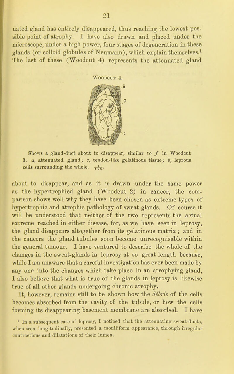 uated gland has entirely disappeared, thus reaching the lowest pos- sible point of atrophy. I have also drawn and placed under the microscope, under a high power, four stages of degeneration in these glands (or colloid globules of Neumann), which explain themselves.1 The last of these (Woodcut 4) represents the attenuated gland Woodcut 4. Shows a gland-duct about to disappear, similar to f in Woodcut 3. a, attenuated gland; c, tendon-like gelatinous tissue; l, leprous cells surrounding the whole. about to disappear, and as it is drawn under the same power as the hypertrophied gland (Woodcut 2) in cancer, the com- parison shows well why they have been chosen as extreme types of hypertrophic and atrophic pathology of sweat glands. Of course it will be understood that neither of the two represents the actual extreme reached in either disease, for, as we have seen in leprosy, the gland disappears altogether from its gelatinous matrix ; and in the cancers the gland tubules soon become unrecognisable within the general tumour. I have ventured to describe the whole of the changes in the sweat-glands in leprosy at so great length because, while I am unaware that a careful investigation has ever been made by any one into the changes which take place in an atrophying gland, I also believe that what is true of the glands in leprosy is likewise true of all other glands undergoing chronic atrophy. It, however, remains still to be shown how the debris of the cells becomes absorbed from the cavity of the tubule, or how the cells forming its disappearing basement membrane are absorbed. I have 1 In a subsequent case of leprosy, I noticed that the attenuating sweat-ducts, when seen longitudinally, presented a moniliform appearance, through irregular contractions and dilatations of their lumen.