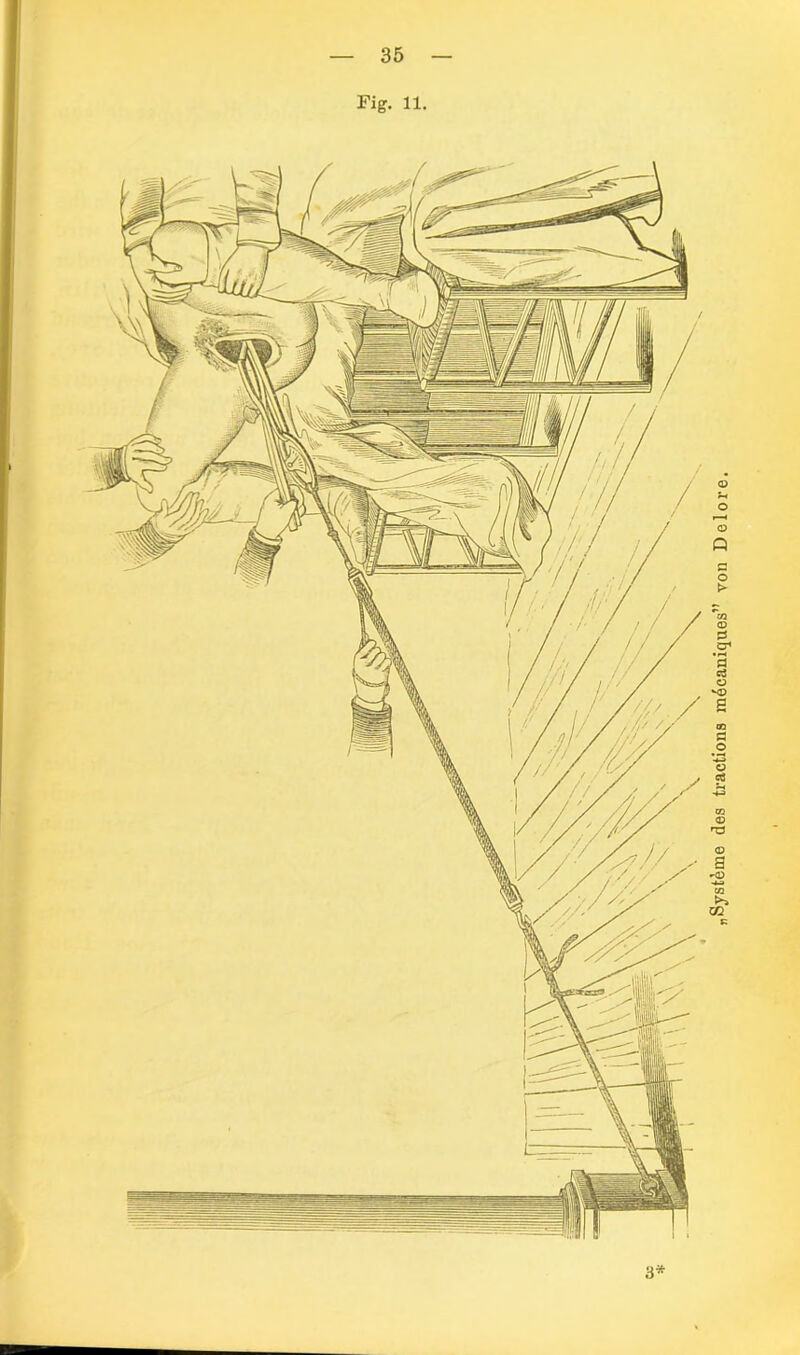 Fig. 11. Systeme des tractions radcaniques” von Delore.