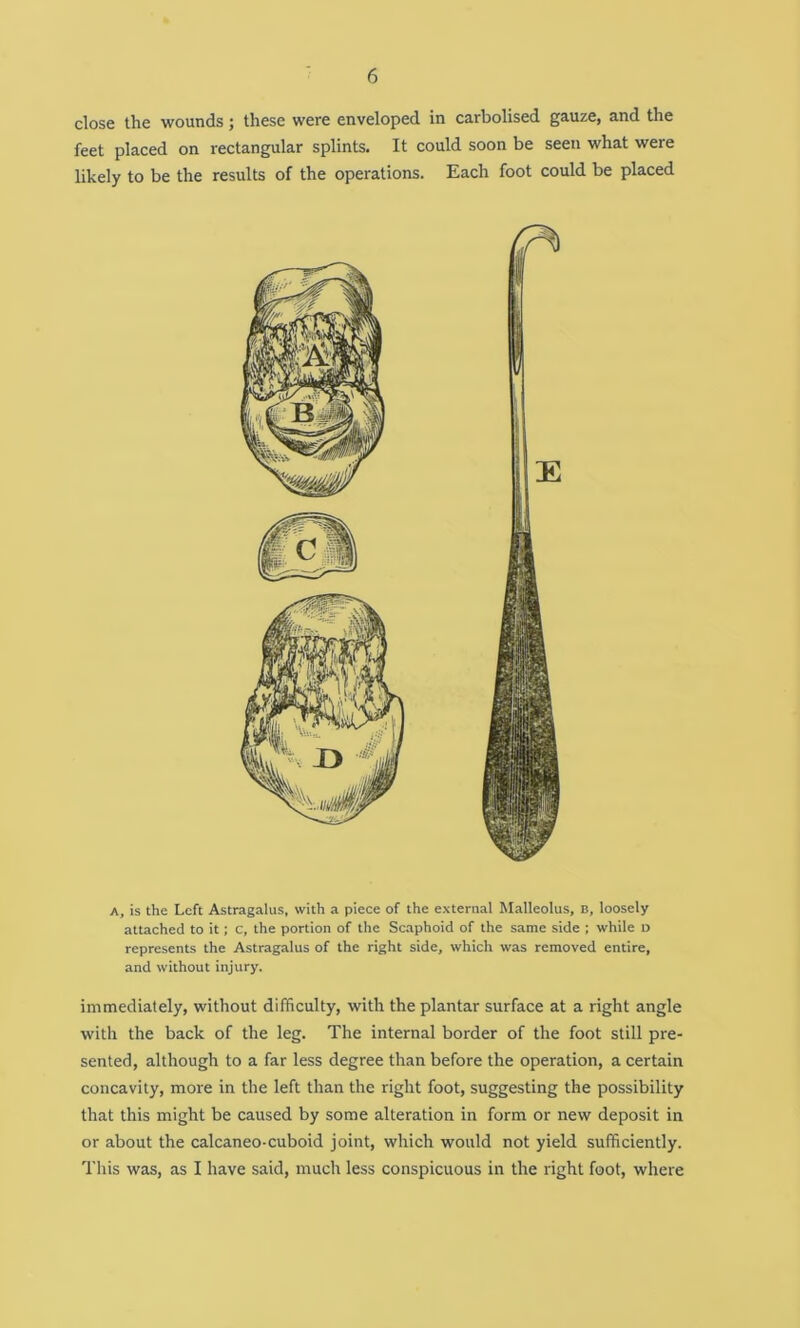 close the wounds; these were enveloped in carbolised gauze, and the feet placed on rectangular splints. It could soon be seen what were likely to be the results of the operations. Each foot could be placed A, is the Left Astragalus, with a piece of the external Malleolus, B, loosely attached to it; c, the portion of the Scaphoid of the same side ; while t> represents the Astragalus of the right side, which was removed entire, and without injury. immediately, without difficulty, with the plantar surface at a right angle with the back of the leg. The internal border of the foot still pre- sented, although to a far less degree than before the operation, a certain concavity, more in the left than the right foot, suggesting the possibility that this might be caused by some alteration in form or new deposit in or about the calcaneo-cuboid joint, which would not yield sufficiently. This was, as I have said, much less conspicuous in the right foot, where