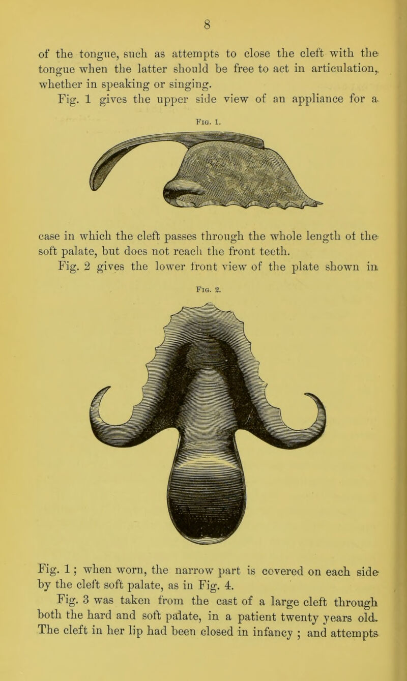 of the tongue, such as attempts to close the cleft with the tongue when the latter should be free to act in articulation,, whether in speaking or singing. Fig. 1 gives the upper side view of an appliance for a Fig. 1. case in which the cleft passes through the whole length ot the soft palate, but does not reach the front teeth. Fig. 2 gives the lower front view of the plate shown in Fig. 2. Fig. 1; when worn, the narrow part is covered on each side by the cleft soft palate, as in Fig. 4. Fig. 3 was taken from the cast of a large cleft through both the hard and soft palate, in a patient twenty years old. The cleft in her lip had been closed in infancy ; and attempts