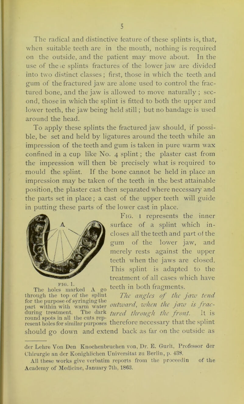 The radical and distinctive feature of these splints is, that, when suitable teeth are in the mouth, nothing is required on the outside, and the patient may move about. In the use of the ,e splints fractures of the lower jaw are divided into two distinct classes; first, those in which the teeth and gum of the fractured jaw are alone used to control the frac- tured bone, and the jaw is allowed to move naturally ; sec- ond, those in which the splint is fitted to both the upper and lower teeth, the jaw being held still; but no bandage is used around the head. To apply these splints the fractured jaw should, if possi- ble, be set and held by ligatures around the teeth while an impression of the teeth and gum is taken in pure warm wax confined in a cup like No. 4 splint; the plaster cast from the impression will then be precisely what is required to mould the splint. If the bone cannot be held in place an impression may be taken of the teeth in the best attainable position, the plaster cast then separated where necessary and the parts set in place; a cast of the upper teeth will guide in putting these parts of the lower cast in place. round spots in all the cuts rep- ' ' resent holes for similar purposes therefore necessary that the splint should go down and extend back as far on the outside as der Lehre Yon Den Knoclienbruchen von, Dr. E. Gurlt, Professor der Chirurgie an der Konighlichen Universitat zu Berlin, p. 438. All these works give verbatim reports from the proceedin of the Academy of Medicine, January 7th, 1863. The holes marked A go through the top of the splint for the purpose of syringing the part within with warm water during treatment. The dark Fig. i represents the inner surface of a splint which in- closes all the teeth and part of the gum of the lower jaw, and merely rests against the upper teeth when the jaws are closed. This splint is adapted to the treatment of all cases which have teeth in both fragments. The angles of the jaw tend outward, when the jaw is frac- tured through the front. It is