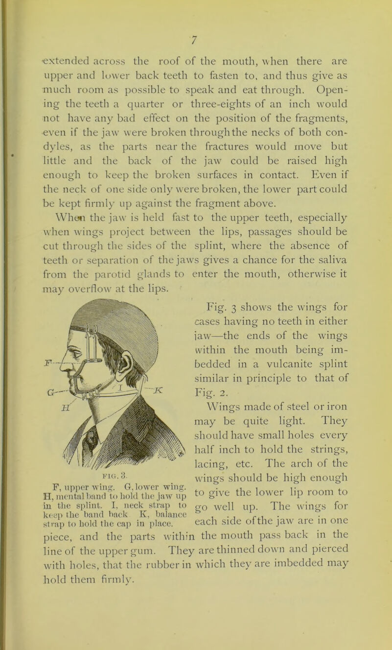 ’extended across the roof of the mouth, when there are upper and lower back teeth to fasten to, and thus give as much room as possible to speak and eat through. Open- ing the teeth a quarter or three-eights of an inch would not have any bad effect on the position of the fragments, •even if the jaw were broken through the necks of both con- dyles, as the parts near the fractures would move but little and the back of the jaw could be raised high enough to keep the broken surfaces in contact. Even if the neck of one side only were broken, the lower part could be kept firmly up against the fragment above. When the jaw is held fast to the upper teeth, especially when wings project between the lips, passages should be cut through the sides of the splint, where the absence of teeth or separation of the jaws gives a chance for the saliva from the parotid glands to enter the mouth, otherwise it may overflow at the lips. Fig. 3 shows the wings for cases having no teeth in either jaw—the ends of the wings within the mouth being im- bedded in a vulcanite splint similar in principle to that of Fig. 2. Wings made of steel or iron may be quite light. They should have small holes every half inch to hold the strings, lacing, etc. The arch of the wings should be high enough to give the lower lip room to go well up. The wings for each side ofthe jaw are in one piece, and the parts within the mouth pass back in the line of the upper gum. They are thinned down and pierced with holes, that the rubber in which they are imbedded may hold them firmly. fig. 3. F, upper wing. G, lower wing. H. mental band to hold the jaw up in the splint. I, neck strap to keep the band back Iv, balance strap to hold the cap in place.