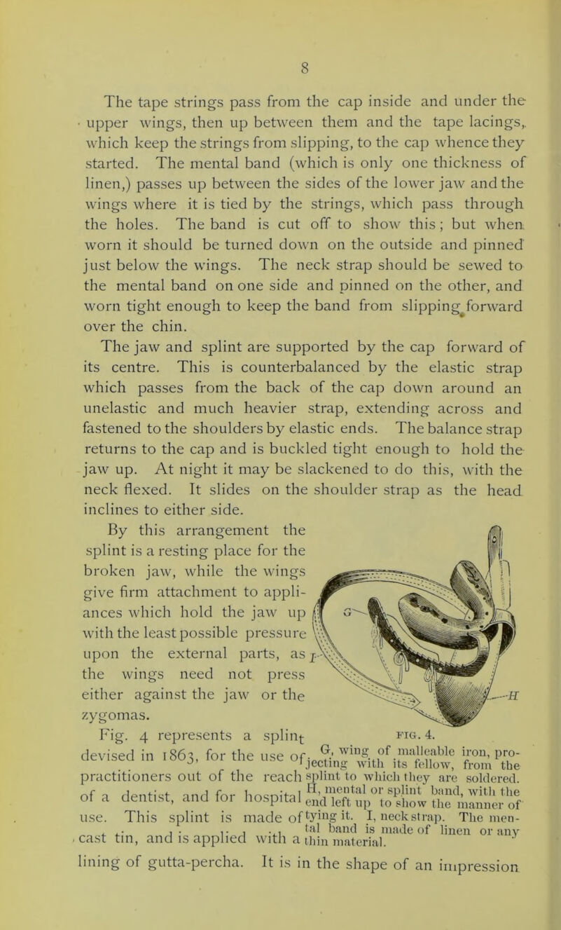 The tape strings pass from the cap inside and under the upper wings, then up between them and the tape lacings,, which keep the strings from slipping, to the cap whence they started. The mental band (which is only one thickness of linen,) passes up between the sides of the lower jaw and the wings where it is tied by the strings, which pass through the holes. The band is cut off to show this; but when worn it should be turned down on the outside and pinned just below the wings. The neck strap should be sewed to the mental band on one side and pinned on the other, and worn tight enough to keep the band from slipping^forward over the chin. The jaw and splint are supported by the cap forward of its centre. This is counterbalanced by the elastic strap which passes from the back of the cap down around an unelastic and much heavier strap, extending across and fastened to the shoulders by elastic ends. The balance strap returns to the cap and is buckled tight enough to hold the jaw up. At night it may be slackened to do this, with the neck flexed. It slides on the shoulder strap as the head inclines to either side. By this arrangement the splint is a resting place for the broken jaw, while the wings give firm attachment to appli- ances which hold the jaw up with the least possible pressure upon the external parts, as j.-> the wings need not press either against the jaw or the zygomas. Fig. 4 represents a splint- devised in 1863, for the use of: t--K FIG. 4. G, wing of malleable iron, pro- jecting with its fellow, from the practitioners out of the reach splint to which they are soldered. q rtf»n(-iet onH fnr br>cr>,>al H>mental or spliiA band, with the ot a dentist, and toi hospital en(j Jeft Up to show the manner of use. This splint is made of ty1® it. I, neckstrap. The men- , , ■ , • , ... tal band is made of linen or anv cast tin, and is applied with a thin material. lining of gutta-percha. It is in the shape of an impression