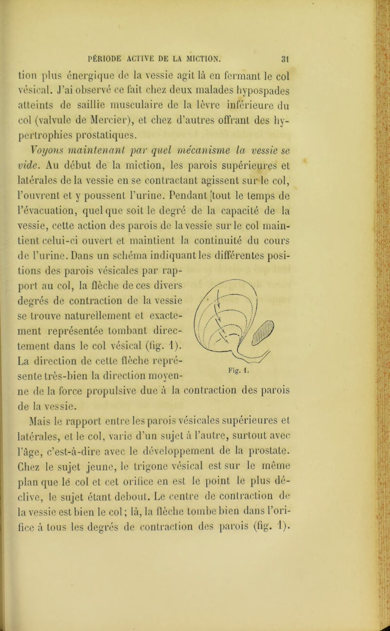 tion plus énergique de la vessie agit là en fermant le col vésical. J’ai observé ce fait chez deux malades hypospades atteints de saillie musculaire de la lèvre inférieure du col (valvule de Mercier), et chez d’autres offrant des hy- pertrophies prostatiques. Voyons maintenant par quel mécanisme la vessie se vide. Au début de la miction, les parois supérieures et latérales de la vessie en se contractant agissent sur le col, l’ouvrent et y poussent l’urine. Pendant [tout le temps de l’évacuation, quel que soit le degré de la capacité de la vessie, cette action des parois de la vessie sur le col main- tient celui-ci ouvert et maintient la continuité du cours de l’urine. Dans un schéma indiquant les différentes posi- tions des parois vésicales par rap- port au col, la flèche de ces divers degrés de contraction de la vessie se trouve naturellement et exacte- ment représentée tombant direc- tement dans le col vésical (fig. 1). La direction de cette flèche repré- sente très-bien la direction moyen- ne de la force propulsive due à la contraction des parois de la vessie. Mais le rapport entre les parois vésicales supérieures et latérales, et le col, varie d’un sujet à l’autre, surtout avec l’âge, c’est-à-dire avec le développement de la prostate. Chez le sujet jeune, le trigone vésical est sur le meme plan que lé col et cet oriiiee en est le point le plus dé- clive, le sujet étant debout. Le centre de contraction de la vessie est bien le col; là, la flèche tombe bien dans l’ori- fice à tous les degrés de contraction des parois (fig. 1).