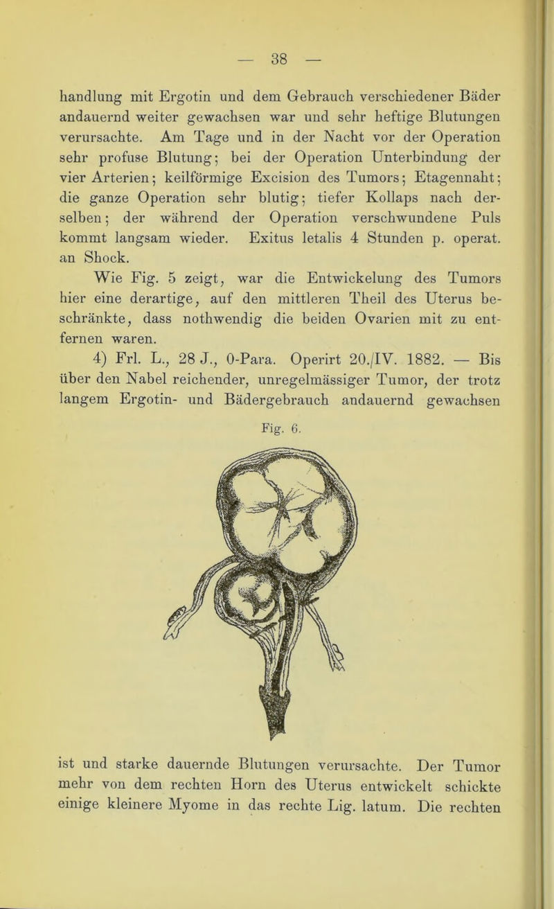 handlung mit Ergotin und dem Gebrauch verschiedener Bäder andauernd weiter gewachsen war und sehr heftige Blutungen verursachte. Am Tage und in der Nacht vor der Operation sehr profuse Blutung; bei der Operation Unterbindung der vier Arterien; keilförmige Excision des Tumors; Etagennaht; die ganze Operation sehr blutig; tiefer Kollaps nach der- selben ; der während der Operation verschwundene Puls kommt langsam -wieder. Exitus letalis 4 Stunden p. operat. an Shock. Wie Fig. 5 zeigt, war die Entwickelung des Tumors hier eine derartige, auf den mittleren Theil des Uterus be- schränkte, dass nothwendig die beiden Ovarien mit zu ent- fernen waren. 4) Frl. L., 28 J., O-Para. Operirt 20./IV. 1882. — Bis über den Nabel reichender, unregelmässiger Tumor, der trotz langem Ergotin- und Bädergebrauch andauernd gewachsen Fig. 6. ist und starke dauernde Blutungen verursachte. Der Tumor mehr von dem rechten Horn des Uterus entwickelt schickte einige kleinere Myome in das rechte Lig. latum. Die rechten