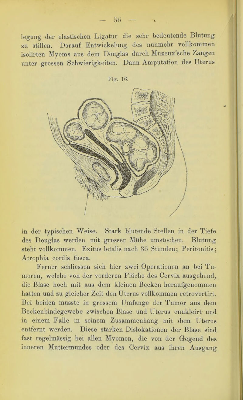 legung der elastischen Ligatur die sehr bedeutende Blutung zu stillen. Darauf Entwickelung des nunmehr vollkommen isolirten Myoms aus dem Douglas durch Muzeux’sche Zangen unter grossen Schwierigkeiten. Dann Amputation des Uterus Fig. 16. in der typischen Weise. Stark blutende Stellen in der Tiefe des Douglas werden mit grosser Mühe umstochen. Blutung steht vollkommen. Exitus letalis nach 36 Stunden; Peritonitis; Atrophia cordis fusca. Ferner schliessen sich hier zwei Operationen an bei Tu- moren, welche von der vorderen Fläche des Cervix ausgehend, die Blase hoch mit aus dem kleinen Becken heraufgenommen hatten und zu gleicher Zeit den Uterus vollkommen retrovertirt. Bei beiden musste in grossem Umfange der Tumor aus dem Beckenbindegewebe zwischen Blase und Uterus enukleirt und in einem Falle in seinem Zusammenhang mit dem Uterus entfernt werden. Diese starken Dislokationen der Blase sind fast regelmässig bei allen Myomen, die von der Gegend des inneren Muttermundes oder des Cervix aus ihren Ausgang