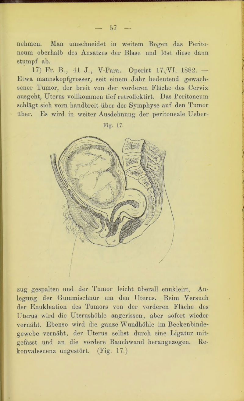 nehmen. Man umschneidet in weitem Bogen das Perito- neum oberhalb des Ansatzes der Blase und löst diese dann stumpf ab. | 17) Fr. B., 41 J., V-Para. Operirt 17./VI. 1882. — | Etwa mannskopfgrosser, seit einem Jahr bedeutend gewaeh- * sener Tumor, der breit von der vorderen Fläche des Cervix ausgeht, Uterus vollkommen tief retroflektirt. Das Peritoneum schlägt sich vorn handbreit über der Symphyse auf den Tumor über. Es wird in weiter Ausdehnung der peritoneale Ueber- Fig. 17. | zug gespalten und der Tumor leicht überall enukleirt. An- legung der Gummischnur um den Uterus. Beim Versuch der Enukleation des Tumors von der vorderen Fläche des Uterus wird die Uterushöhle angerissen, aber sofort wieder vernäht. Ebenso wird die ganze Wundhöhle im Beckenbinde- gewebe vernäht, der Uterus selbst durch eine Ligatur mit- gefasst und an die vordere Bauchwand herangezogen. Re- konvalescenz ungestört. (Fig. 17.)