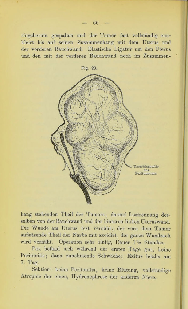 ringsherum gespalten und der Tumor fast vollständig enu- kleirt bis auf seinen Zusammenhang mit dem Uterus und der vorderen Bauchwand. Elastische Ligatur um den Uterus und den mit der vorderen Bauchwand noch im Zusammen- Fig. 23. hang stehenden Theil des Tumors; darauf Lostrennung des- selben von der Bauchwand und der hinteren linken Uteruswand. Die Wunde am Uterus fest vernäht; der vorn dem Tumor aufsitzende Theil der Narbe mit excidirt, der ganze Wundsack wird vernäht. Operation sehr blutig, Dauer 1 x/2 Stunden. Pat. befand sich während der ersten Tage gut, keine Peritonitis; dann zunehmende Schwäche; Exitus letalis am 7. Tag. Sektion: keine Peritonitis, keine Blutung, vollständige Atrophie der einen, Hydronephrose der anderen Niere.