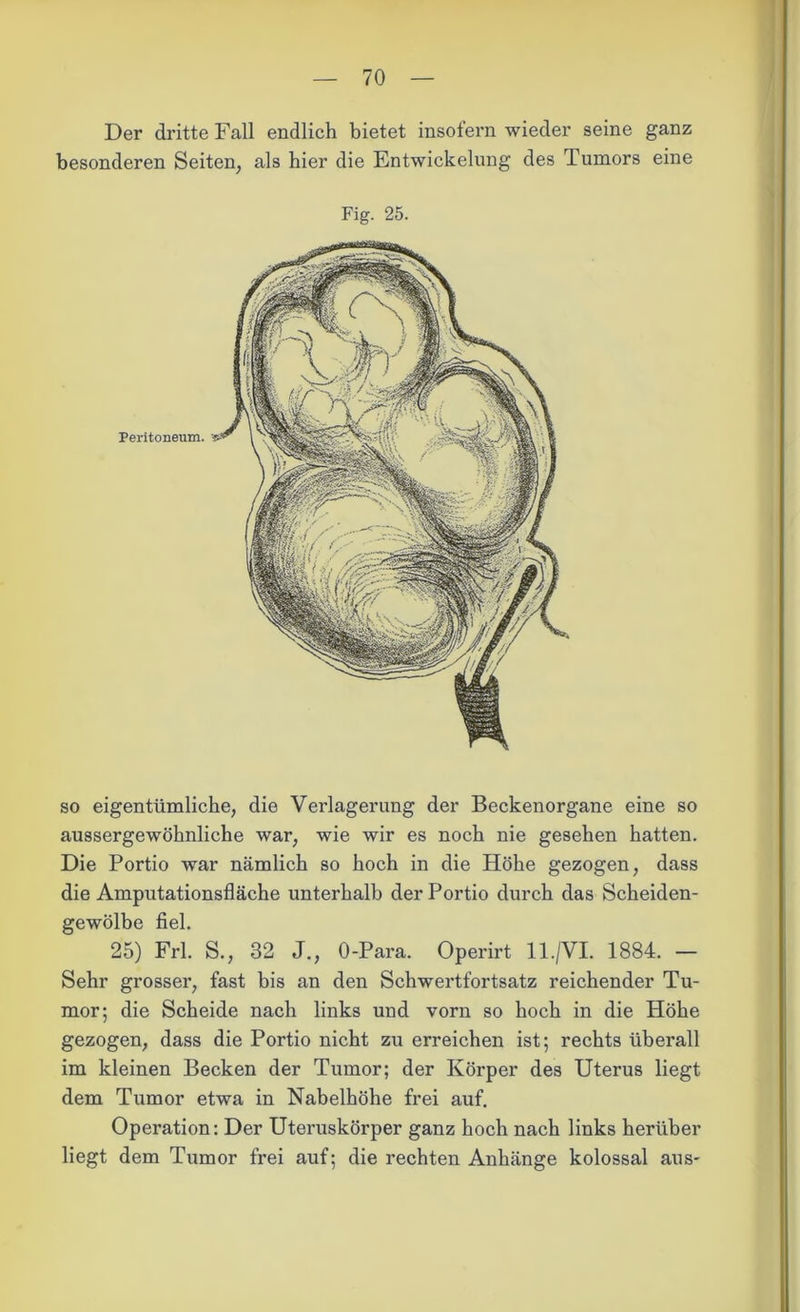 Der dritte Fall endlich bietet insofern wieder seine ganz besonderen Seiten, als hier die Entwickelung des Tumors eine Fig. 25. so eigentümliche, die Verlagerung der Beckenorgane eine so aussergewöhnliche war, wie wir es noch nie gesehen hatten. Die Portio war nämlich so hoch in die Höhe gezogen, dass die Amputationsfläche unterhalb der Portio durch das Scheiden- gewölbe fiel. 25) Frl. S., 32 J., O-Para. Operirt 11./VI. 1884. — Sehr grosser, fast bis an den Schwertfortsatz reichender Tu- mor; die Scheide nach links und vorn so hoch in die Höhe gezogen, dass die Portio nicht zu erreichen ist; rechts überall im kleinen Becken der Tumor; der Körper des Uterus liegt dem Tumor etwa in Nabelhöhe frei auf. Operation: Der Uteruskörper ganz hoch nach links herüber liegt dem Tumor frei auf; die rechten Anhänge kolossal aus-