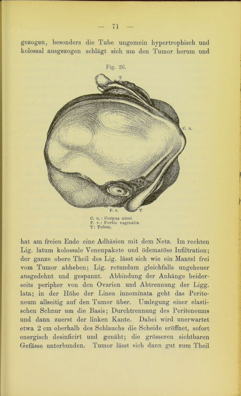 gezogen, besonders die Tube ungemein hypertrophisch und kolossal ausgezogen schlägt sich um den Tumor herum und Fig. 2G. C. u.: Corpus Uteri. P. y.: Portio vaginalis. T: Tuben. hat am freien Ende eine Adhäsion mit dem Netz. Im rechten Lig. latum kolossale Venenpakete und ödematöse Infiltration; der ganze obere Theil des Lig. lässt sich wie ein Mantel frei vom Tumor abheben; Lig. rotundum gleichfalls ungeheuer ansgedehnt und gespannt. Abbindung der Anhänge beider- seits peripher von den Ovarien und Abtrennung der Ligg. lata; in der Höhe der Linea innominata geht das Perito- neum allseitig auf den Tumor über. Umlegung einer elasti- schen Schnur um die Basis; Durchtrennung des Peritoneums und dann zuerst der linken Kante. Dabei wird unerwartet etwa 2 cm oberhalb des Schlauchs die Scheide eröffnet, sofort energisch desinficirt und genäht; die grösseren sichtbaren Gefässe unterbunden. Tumor lässt sich dann gut zum Theil