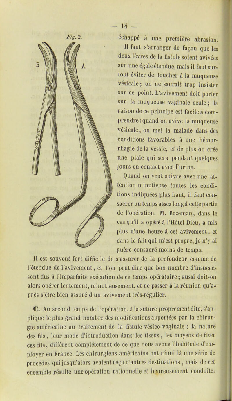 2- échappé à une première abrasion. Il faul s’arranger de façon que les deux lèvres de la fistule soient avivées sur une égale étendue, mais il faut sur- tout éviter de loucher à la muqueuse vésicale ; on ne saurait trop insister sur ce point. L’avivement doit porter sur la muqueuse vaginale seule; la raison de ce principe est facile à com- prendre: quand on avive la muqueuse vésicale, on met la malade dans des conditions favorables à une hémor- rhagie de la vessie, et de plus on crée une plaie qui sera pendant quelques jours en contact avec l’urine. Quand on veut suivre avec une at- tention minutieuse toutes les condi- tions indiquées plus haut, il faut con- sacrer un temps assez long à celte partie de l’opération. M. Bozeman, dans le cas qu’il a opéré à l’Hôlel-Dieu, a mis plus d’une heure à cet avivement, et dans le fait qui m’est propre, je n’y ai guère consacré moins de temps. Il est souvent fort difficile de s’assurer de la profondeur comme de l’étendue de l’avivement, et l’on peut dire que bon nombre d’insuccès sont dus à l’imparfaite exécution de ce temps opératoire; aussi doit-on alors opérer lentement, minutieusement, et ne passer à la réunion qu’a- près s’ètre bien assuré d’un avivement très-régulier. C. Au second temps de l’opération, à la suture proprement dite, s’ap- plique le plus grand nombre des modifications apportées par la chirur- gie américaine au traitement de la fistule vésico-vaginale : la nature des fils, leur mode d’introduction dans les tissus, les moyens de fixer Ces fils, diffèrent complètement de ce que nous avons l’habitude d’em- ployer en France. Les chirurgiens américains ont réuni là une série de procédés qui jusqu’alors avaient reçu d’autres destinations, mais de cet ensemble résulte une opération rationnelle et heureusement conduite.