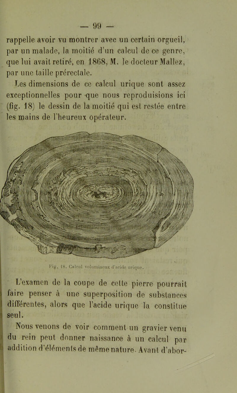 rappelle avoir vu montrer avec un certain orgueil, par un malade, la moitié d’un calcul de ce genre, que lui avait retiré, en 1868, M. le docteur Mallez, par une taille prérectale. Les dimensions de ce calcul urique sont assez exceptionnelles pour que nous reproduisions ici (fig. 18) le dessin de la moitié qui est restée entre les mains de l’heureux opérateur. Kig. 18. Calcul volumineux d'acide urique. L’examen de la coupe de celle pierre pourrait faire penser à une superposition de substances différentes, alors que l’acide urique la constitue i seul. Nous venons de voir comment un gravier venu du rein peut donner naissance à un calcul par ü addition d’éléments de même nature. Avant d’abor-