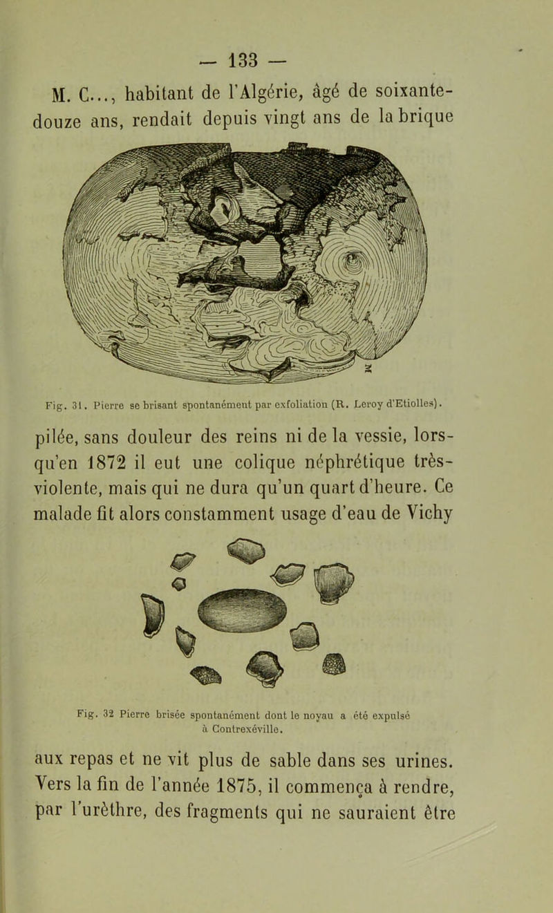 M. C..., habitant de l’Algérie, âgé de soixante- douze ans, rendait depuis vingt ans de la brique Fig. 31. Pierre se brisant spontanément par exfoliation (R. Leroy d'Etiolles). pilée, sans douleur des reins ni de la vessie, lors- qu’en 1872 il eut une colique néphrétique très- violente, niais qui ne dura qu’un quart d’heure. Ce malade fit alors constamment usage d’eau de Vichy Fig. 32 Pierre brisée spontanément dont le noyau a été expulsé à Contrexéville. aux repas et ne vit plus de sable dans ses urines. Vers la fm de l’année 1875, il commença à rendre, par 1 urèthre, des fragments qui ne sauraient être