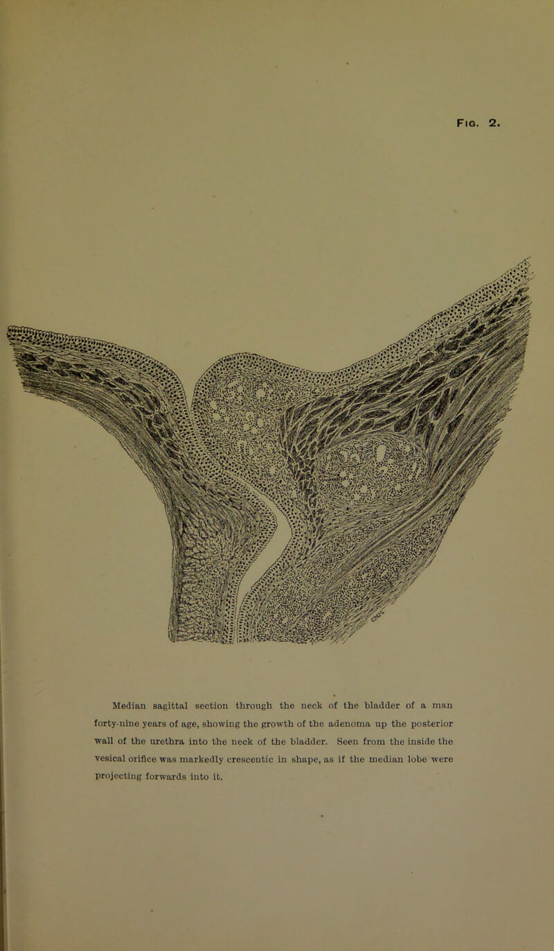 Fig 2 tsmmmm mm mm Median sagittal section through the neck of the bladder of a man forty-nine years of age, showing the growth of the adenoma up the posterior wall of the urothra into the neck of the bladder. Seen from the inside the vesical orifice was markedly crescentic in shape, as if the median lobe were projecting forwards into it.