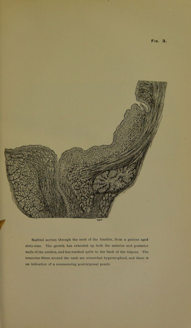 Sagittal section through the neck of the bladder, from a patient aged sixty-nine. The growth has extended up both the anterior and posterior walls of the urethra, and has reached quite to the back of the trigone. The muscular fibres around the neck are somewhat hypertrophied, and there is an indication of a commencing post-trigonal pouch.
