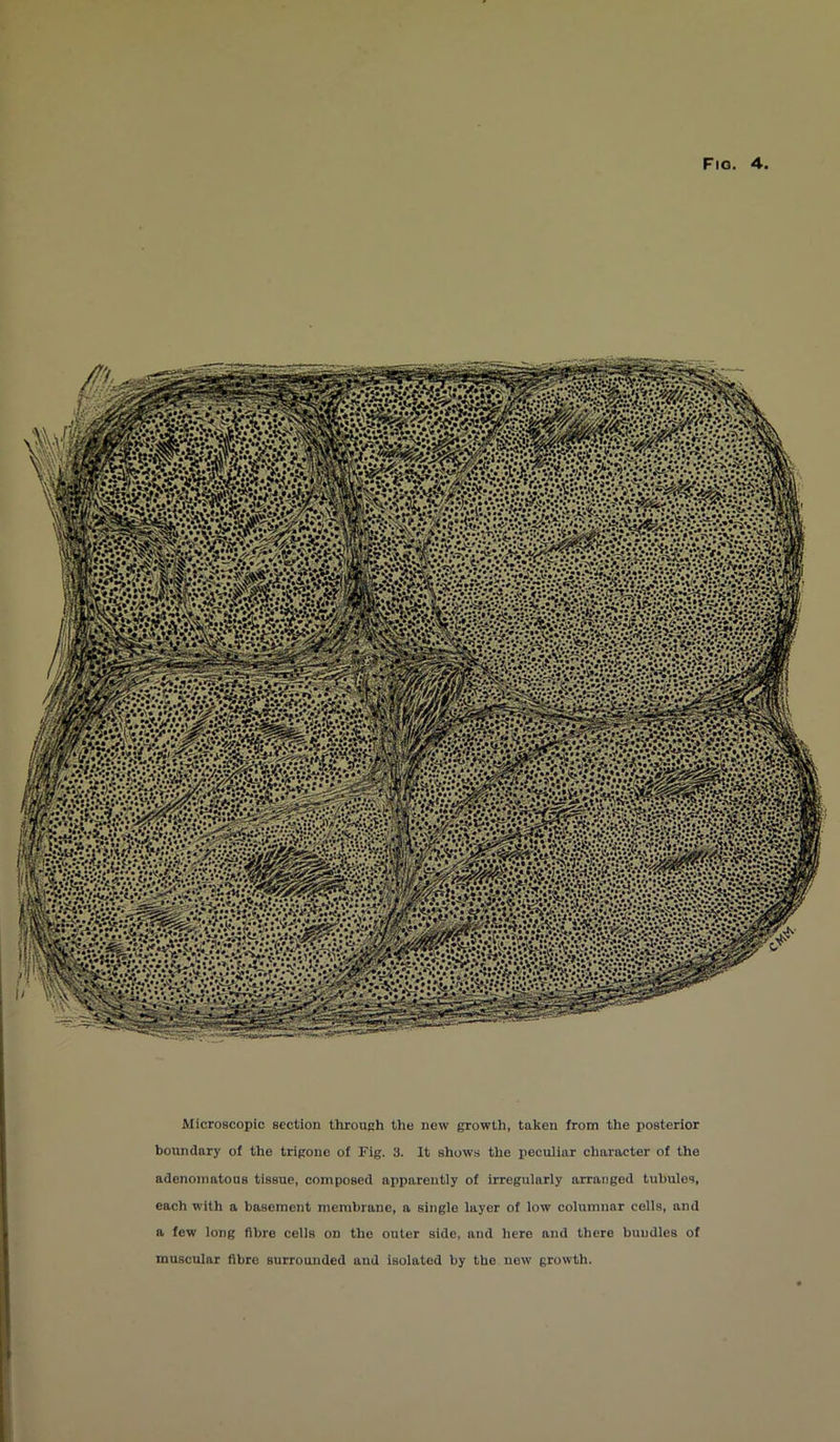 : •*•. *•?.*. *..!•* •> • V i ::.s.: •/. • y. . :A^<f---’*:y:v.-Vv-.-'■ •r$&f1sEi /.>;::;.;v/:-Vgvy IHB • • ?,‘,V **♦?? • * ••(? itS^lfil ;; •• .•••< *A>\ ± - i^i*. •* ;>; 'V* •> * rSi • r i1 *-*i y S» taMp 4:’vV> \zj&&*: if: vmm&sai rz****** Microscopic section through the new growth, taken from the posterior boundary of the trigone of Fig. 3. It shows the peculiar character of the adenomatous tissue, composed apparently of irregularly arranged tubules, each with a basement membrane, a single layer of low columnar cells, and a few long fibre cells on the outer side, and here and there bundles of muscular fibre surrounded aud isolated by the new growth.