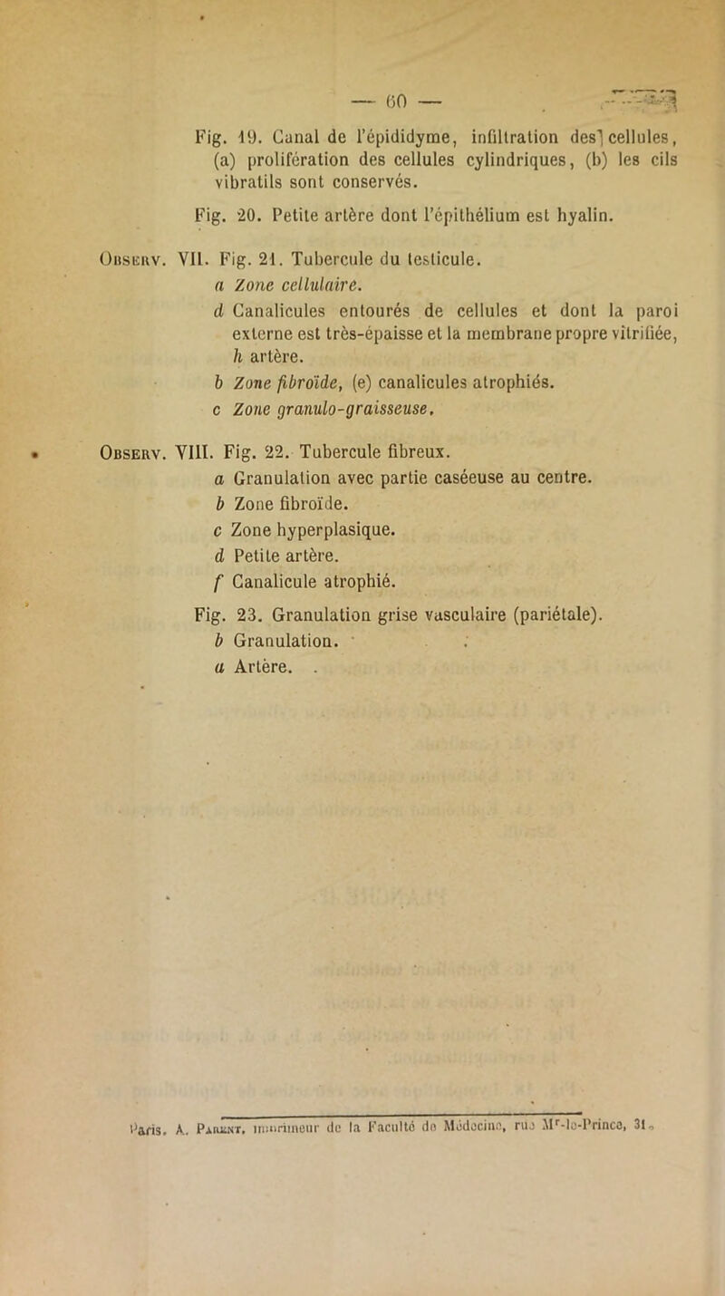 (50 — Fig. •19. Canal de l’épididyme, infiltration des] cellules, (a) prolifération des cellules cylindriques, (b) les cils vibratils sont conservés. Fig. 20. Petite artère dont l’épithélium est hyalin. üiisKKv. VU. Fig. 21. Tubercule du lesticule. a Zone cellulaire. d Canalicules entourés de cellules et dont la paroi externe est très-épaisse et la membrane propre vitrifiée, h artère. b Zone fibrdide, (e) canalicules atrophiés, c Zone granulo-graisseuse. O Granulation avec partie caséeuse au centre. b Zone fibroïde. c Zone hyperplasique. d Petite artère. f Canalicule atrophié. Fig. 23. Granulation grise vasculaire (pariétale). b Granulation. a Artère. . iWis. A. Paiiïnt. iniiiriineiii' do la Faculté do Médocino, ruj IP-lu-Princo, 31, l-OlJ