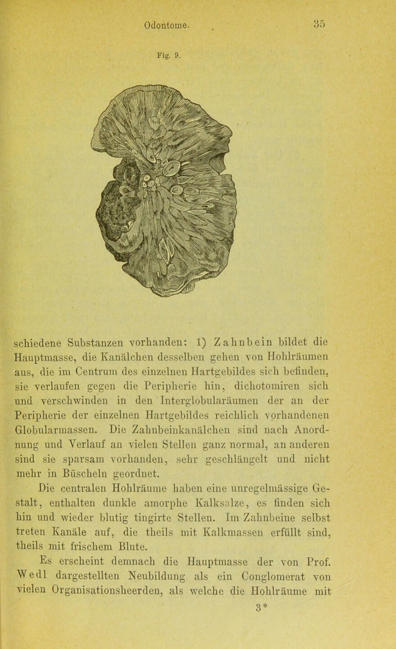 Fig. 9. schiedene Substanzen vorhanden: 1) Zahnbein bildet die Hauptmasse, die Kanälchen desselben gehen von Hohlräumen aus, die im Centrum des einzelnen Hartgebildes sich befinden, sie verlaufen gegen die Peripherie hin, dichotomiren sich und verschwinden in den lnterglobularäumen der an der Peripherie der einzelnen Hartgebildes reichlich vorhandenen Globularmassen. Die Zahnbeinkanälchen sind nach Anord- nung und Verlauf an vielen Stellen ganz normal, an anderen sind sie sparsam vorhanden, sehr geschlängelt und nicht mehr in Büscheln geordnet. Die centralen Hohlräume haben eine unregelmässige Ge- stalt, enthalten dunkle amorphe Kalksalze, es finden sich hin und wieder blutig tingirte Stellen. Im Zahnbeine selbst treten Kanäle auf, die theils mit Kalkmassen erfüllt sind, theils mit frischem Blute. Es erscheint demnach die Hauptmasse der von Prof. Wedl dargestellten Neubildung als ein Conglomerat von vielen Organisationsheerden, als welche die Hohlräume mit 3 *