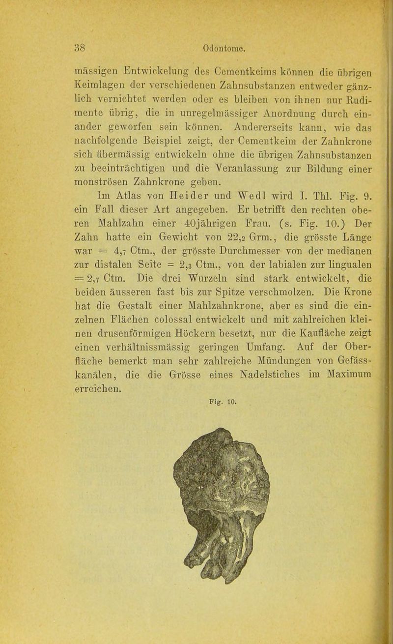 ' ) 38 Odontome. massigen Entwickelung des Cementkeims können die übrigen Keimlagen der verschiedenen Zahnsubstanzen entweder gänz- lich vernichtet werden oder es bleiben von ihnen nur Rudi- mente übrig, die in unregelmässiger Anordnung durch ein- ander geworfen sein können. Andererseits kann, wie das nachfolgende Beispiel zeigt, der Cementkeim der Zahnkrone sich übermässig entwickeln ohne die übrigen Zahnsubstanzen zu beeinträchtigen und die Veranlassung zur Bildung einer monströsen Zahnkrone geben. Im Atlas von Hei der und Wedl wird I. Thl. Fig. 9. ein Fall dieser Art angegeben. Er betrifft den rechten obe- ren Mahlzahn einer 40jährigen Frau. (s. Fig. 10.) Der Zahn hatte ein Gewicht von 22,2 Grm., die grösste Länge war = 4,7 Ctm., der grösste Durchmesser von der medianen zur distalen Seite = 2,3 Ctm., von der labialen zur lingualen = 2,7 Ctm. Die drei Wurzeln sind stark entwickelt, die beiden äusseren fast bis zur Spitze verschmolzen. Die Krone hat die Gestalt einer Mahlzahnkrone, aber es sind die ein- zelnen Flächen colossal entwickelt und mit zahlreichen klei- nen drusenförmigen Höckern besetzt, nur die Kaufläche zeigt einen verhältnissmässig geringen Umfang. Auf der Ober- fläche bemerkt man sehr zahlreiche Mündungen von Gefäss- kanälen, die die Grösse eines Nadelstiches im Maximum erreichen. Fig. 10.