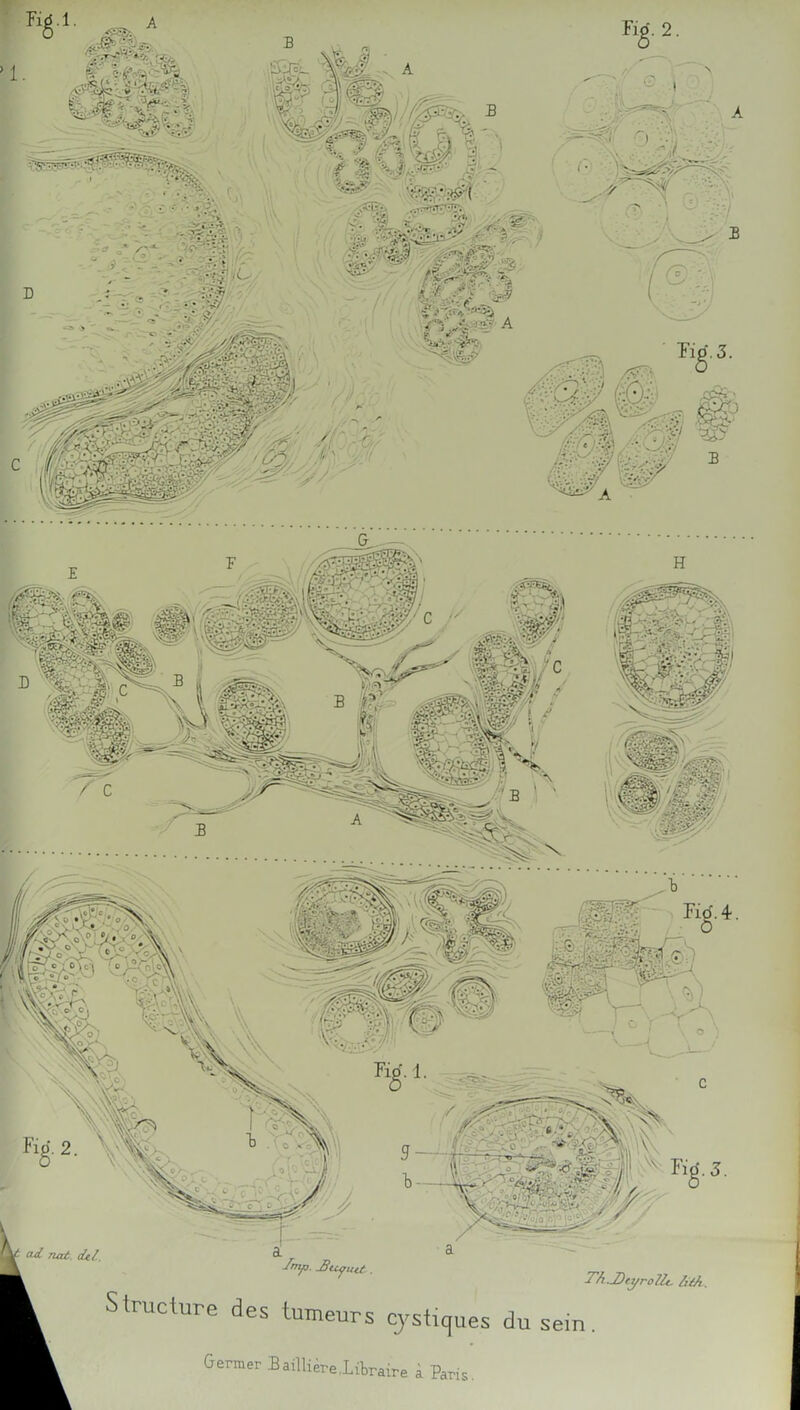 A B .2. ^ 7iat. dtl. Structure des tumeurs cjstiques du Gemer Baillièrelitraire à Paris. T/i.DtyroUt. l)éA. sein .