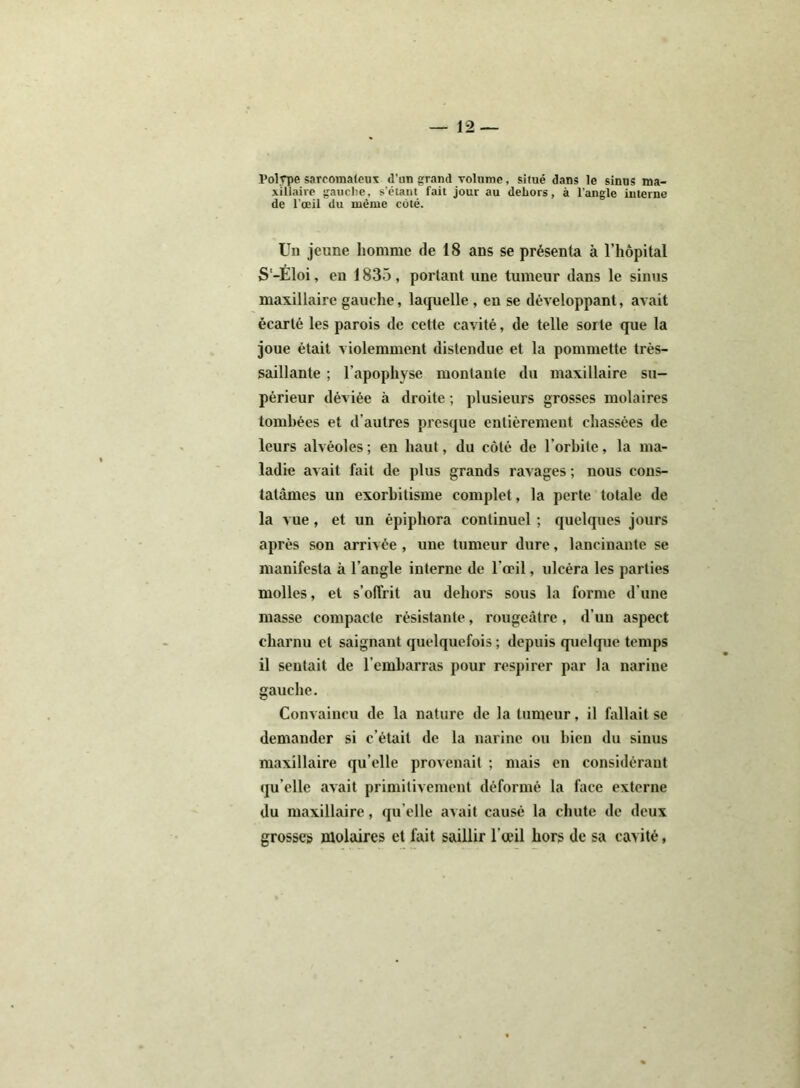 Polype sarcomateux d’un grand volume, situé dans le sinus ma- xillaire gauche, s’élant fait jour au dehors, à l'angle interne de l’œil du même côté. Un jeune homme de 18 ans se présenta à l'hôpital S'-Éloi, en 1835, portant une tumeur dans le sinus maxillaire gauche, laquelle, en se développant, avait écarté les parois de cette cavité, de telle sorte que la joue était violemment distendue et la pommette très- saillante ; h apophyse montante du maxillaire su- périeur déviée à droite ; plusieurs grosses molaires tombées et d’autres presque entièrement chassées de leurs alvéoles; en haut, du côté de l’orbite, la ma- ladie avait fait de plus grands ravages ; nous cons- tatâmes un exorhitisme complet, la perte totale de la vue, et un épiphora continuel ; quelques jours après son arrivée , une tumeur dure, lancinante se manifesta à l’angle interne de l’oeil, ulcéra les parties molles, et s’offrit au dehors sous la forme d’une masse compacte résistante, rougeâtre, d’un aspect charnu et saignant quelquefois ; depuis quelque temps il sentait de l’embarras pour respirer par la narine gauche. Convaincu de la nature de la tumeur, il fallait se demander si c’était de la narine ou bien du sinus maxillaire qu elle provenait ; mais en considérant qu elle avait primitivement déformé la face externe du maxillaire, qu elle avait causé la chute de deux grosses molaires et fait saillir l’œil hors de sa cavité,