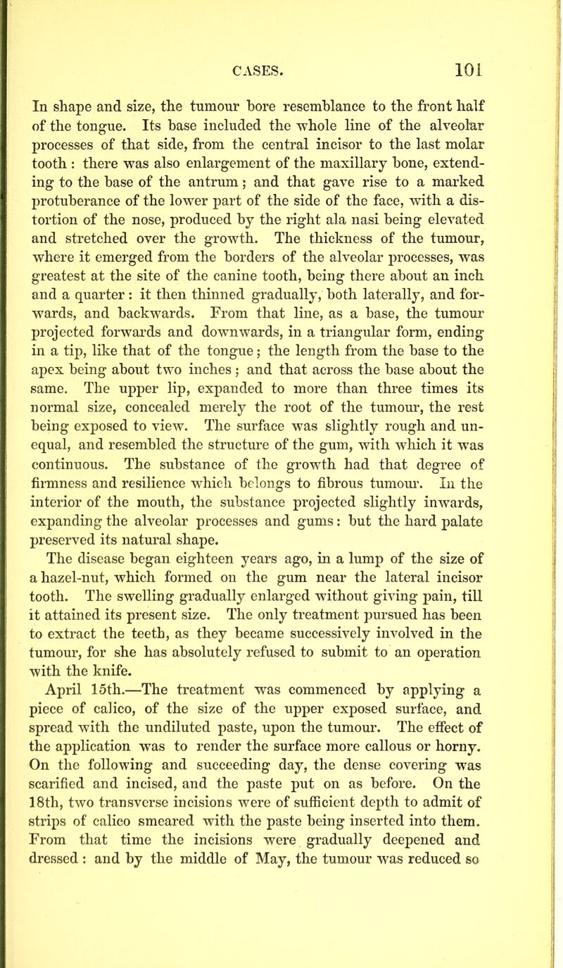 In shape and size, the tumour bore resemblance to the front half of the tongue. Its base included the whole line of the alveolar processes of that side, from the central incisor to the last molar tooth : there was also enlargement of the maxillary hone, extend- ing to the base of the antrum; and that gave rise to a marked protuberance of the lower part of the side of the face, with a dis- tortion of the nose, produced by the right ala nasi being elevated and stretched over the growth. The thickness of the tumour, where it emerged from the borders of the alveolar processes, was greatest at the site of the canine tooth, being there about an inch and a quarter : it then thinned gradually, both laterally, and for- wards, and backwards. From that line, as a base, the tumour projected forwards and downwards, in a triangular form, ending in a tip, like that of the tongue; the length from the base to the apex being about two inches ; and that across the base about the same. The upper lip, expanded to more than three times its normal size, concealed merely the root of the tumour, the rest being exposed to view. The surface was slightly rough and un- equal, and resembled the structure of the gum, with which it was continuous. The substance of the growth had that degree of firmness and resilience which belongs to fibrous tumour. In the interior of the mouth, the substance projected slightly inwards, expanding the alveolar processes and gums: but the hard palate preserved its natural shape. The disease began eighteen years ago, in a lump of the size of a hazel-nut, which formed on the gum near the lateral incisor tooth. The swelling gradually enlarged without giving pain, till it attained its present size. The only treatment pursued has been to extract the teeth, as they became successively involved in the tumour, for she has absolutely refused to submit to an operation with the knife. April 15th.—The treatment was commenced by applying a piece of calico, of the size of the upper exposed surface, and spread with the undiluted paste, upon the tumour. The effect of the application was to render the surface more callous or horny. On the following and succeeding day, the dense covering was scarified and incised, and the paste put on as before. On the 18th, two transverse incisions were of sufficient depth to admit of strips of calico smeared with the paste being inserted into them. From that time the incisions were gradually deepened and dressed : and by the middle of May, the tumour was reduced so