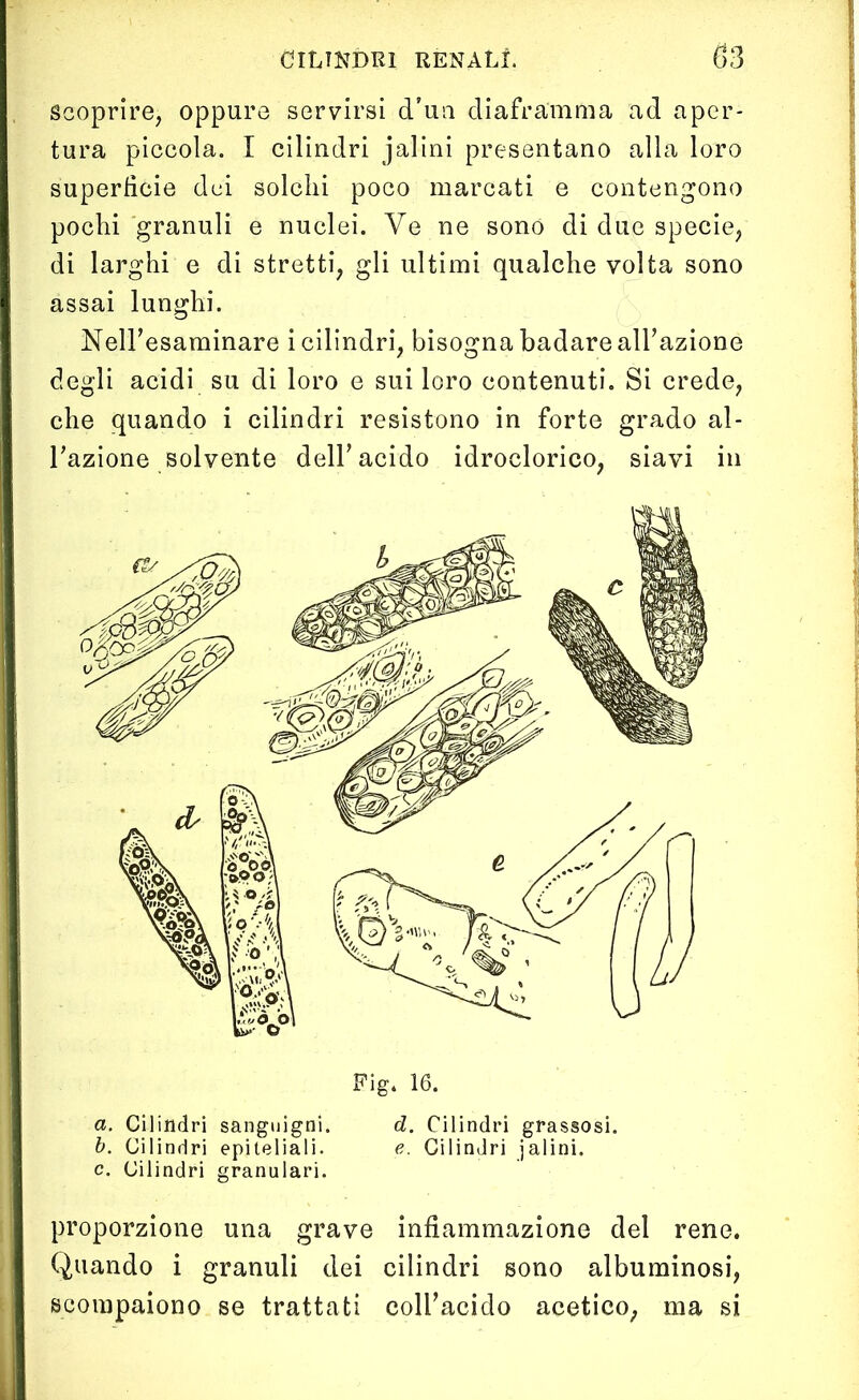 scoprire, oppure servirsi d’un diaframma ad aper- tura piccola. I cilindri jalini presentano alla loro superficie dei solchi poco marcati e contengono pochi granuli e nuclei. Ve ne sono di due specie, di larghi e di stretti, gli ultimi qualche volta sono assai lunghi. Nell’esaminare i cilindri, bisogna badare all’azione degli acidi su di loro e sui loro contenuti. Si crede, che quando i cilindri resistono in forte grado al- Tazione solvente dell’ acido idroclorico, siavi in Fig. 16. a. Cilindri sanguigni. d. Cilindri grassosi. b. Cilindri epiteliali. e. Gilindri jalini. c. Cilindri granulari. proporzione una grave infiammazione del rene. Quando i granuli dei cilindri sono albuminosi, scompaiono se trattati coll’acido acetico, ma si