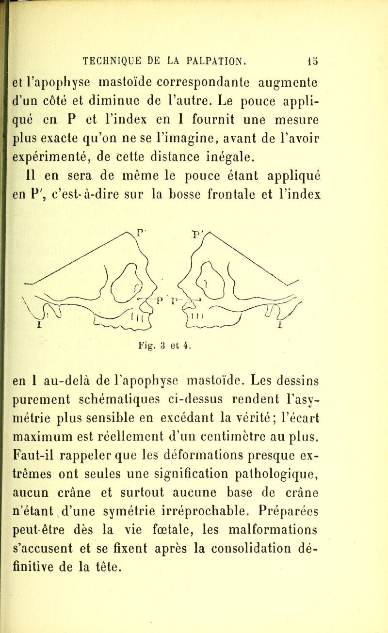 et l’apophyse mastoïde correspondante augmente d’un côté et diminue de l’autre. Le pouce appli- qué en P et l’index en 1 fournit une mesure plus exacte qu’on ne se l’imagine, avant de l’avoir expérimenté, de cette distance inégale. 11 en sera de même le pouce étant appliqué en P', c’est-à-dire sur la bosse frontale et l’index en 1 au-delà de l’apophyse mastoïde. Les dessins purement schématiques ci-dessus rendent l’asy- métrie plus sensible en excédant la vérité; l’écart maximum est réellement d’un centimètre au plus. Faut-il rappeler que les déformations presque ex- trêmes ont seules une signification pathologique, aucun crâne et surtout aucune base de crâne n’étant d’une symétrie irréprochable. Préparées peut être dès la vie fœtale, les malformations s’accusent et se fixent après la consolidation dé- finitive de la tête.