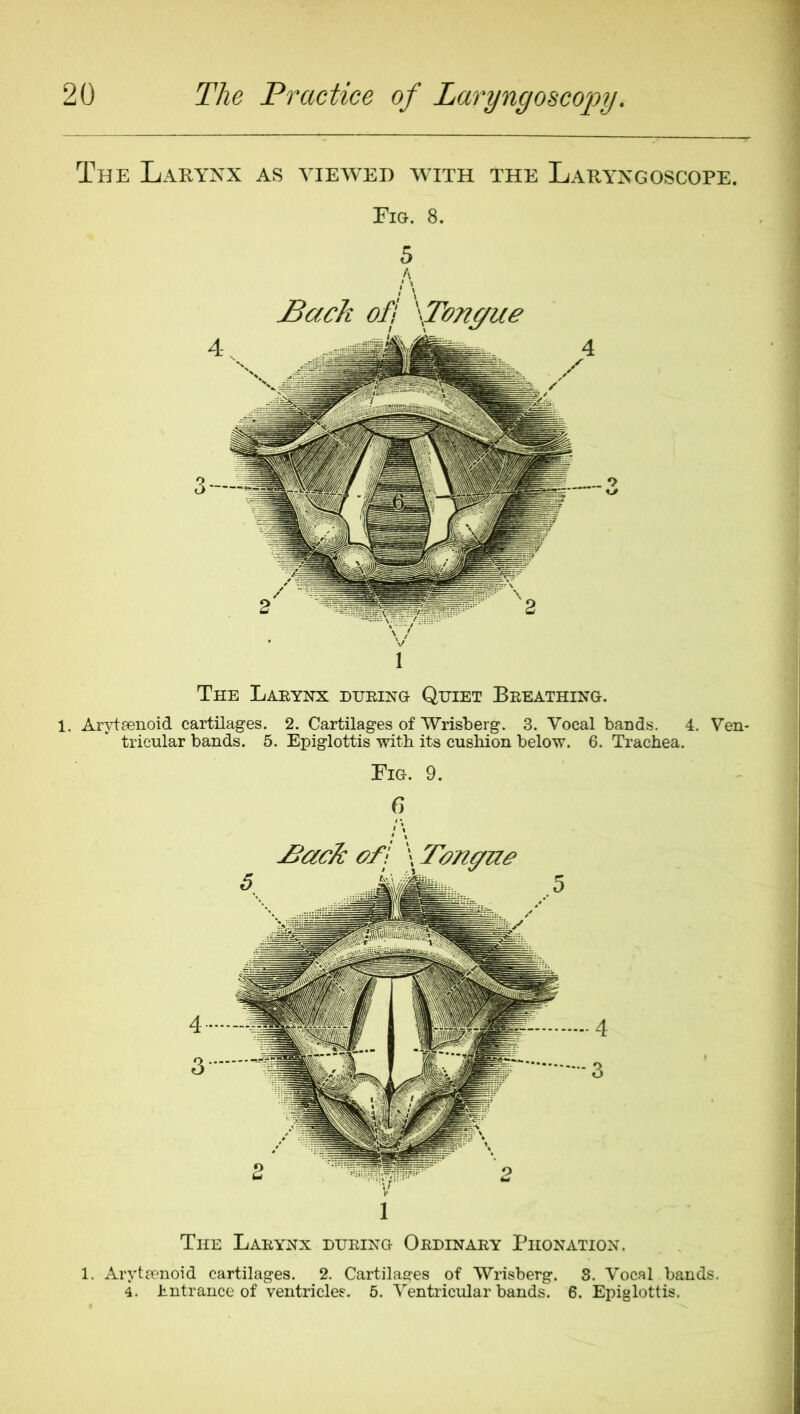 The Larynx as viewed with the Laryngoscope. Fm. 8. 5 1 The Laeynx dijeing Quiet Beeathing. 1, Aryteenoid cartilages. 2. Cartilages of Wrisberg. 3. Vocal bands. 4. Ven- tricular bands. 5. Epiglottis with its cushion below. 6. Trachea. Fig. 9. G ^ack of I \ Tonffuo i The Laeynx dueing Oedinaey Phonation. 1. Arytfenoid cartilages. 2. Cartilages of Wrisberg. 8. Vocal bands. 4. Entrance of ventricles. 5. Ventricular bands. 6. Epiglottis.