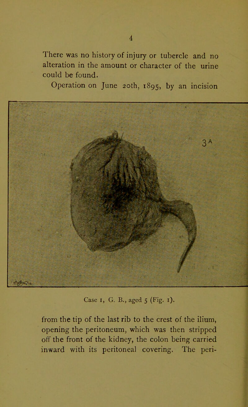 There was no history of injury or tubercle and no alteration in the amount or character of the urine could be found. Operation on June 20th, 1895, by an incision Case 1, G. B., aged 5 (Fig. 1). from the tip of the last rib to the crest of the ilium, opening the peritoneum, which was then stripped off the front of the kidney, the colon being carried inward with its peritoneal covering. The peri-