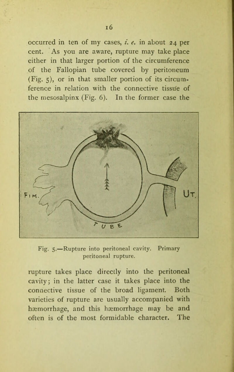 occurred in ten of my cases, i. e. in about 24 per cent. As you are aware, rupture may take place either in that larger portion of the circumference of the Fallopian tube covered by peritoneum (Fig. 5), or in that smaller portion of its circum- ference in relation with the connective tissue of the mesosalpinx (Fig. 6). In the former case the Fig. 5.—Rupture into peritoneal cavity. Primary peritoneal rupture. rupture takes place directly into the peritoneal cavity; in the latter case it takes place into the connective tissue of the broad ligament. Both varieties of rupture are usually accompanied with htemorrhage, and this haemorrhage may be and often is of the most formidable character. The