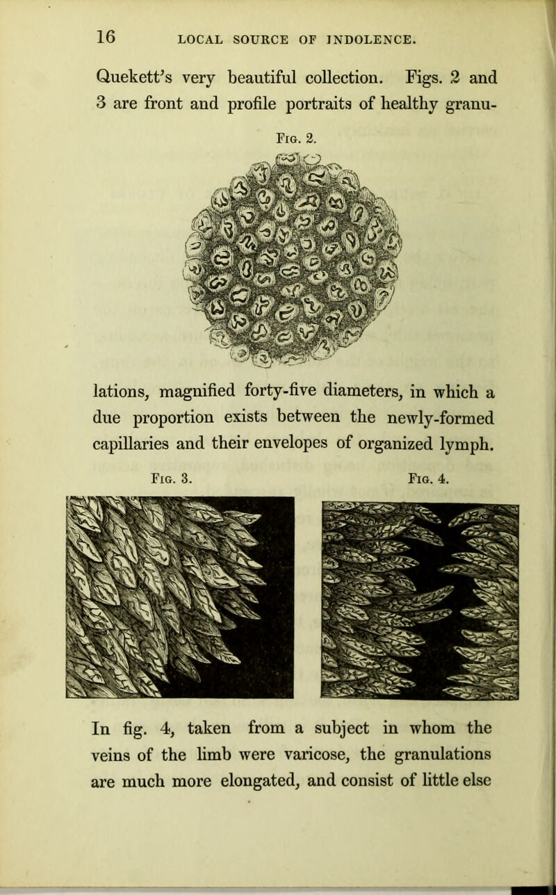 Quekett^s very beautiful collection. Figs. 2 and 3 are front and profile portraits of healthy granu- Fig. 2. lations, magnified forty-five diameters, in which a due proportion exists between the newly-formed capillaries and their envelopes of organized lymph. Fig. 3. Fig. 4. In fig. 4, taken from a subject in whom the veins of the limb were varicose, the granulations are much more elongated, and consist of little else