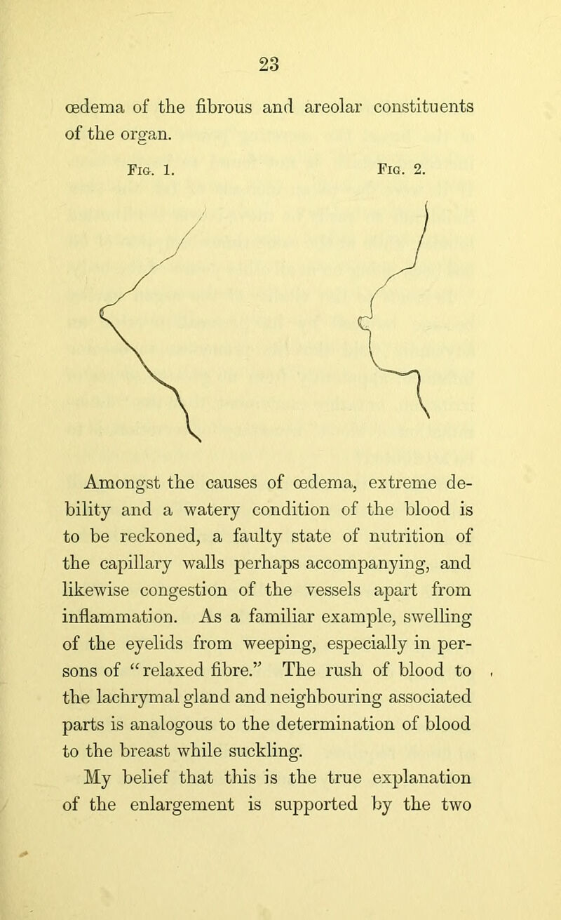 oedema of the fibrous and areolar constituents of the organ. Fig. 1. Fig. 2. Amongst the causes of oedema, extreme de- bility and a watery condition of the blood is to be reckoned, a faulty state of nutrition of the capillary walls perhaps accompanying, and likewise congestion of the vessels apart from inflammation. As a familiar example, swelling of the eyelids from weeping, especially in per- sons of “ relaxed fibre.” The rush of blood to the lachrymal gland and neighbouring associated parts is analogous to the determination of blood to the breast while suckling. My belief that this is the true explanation of the enlargement is supported by the two