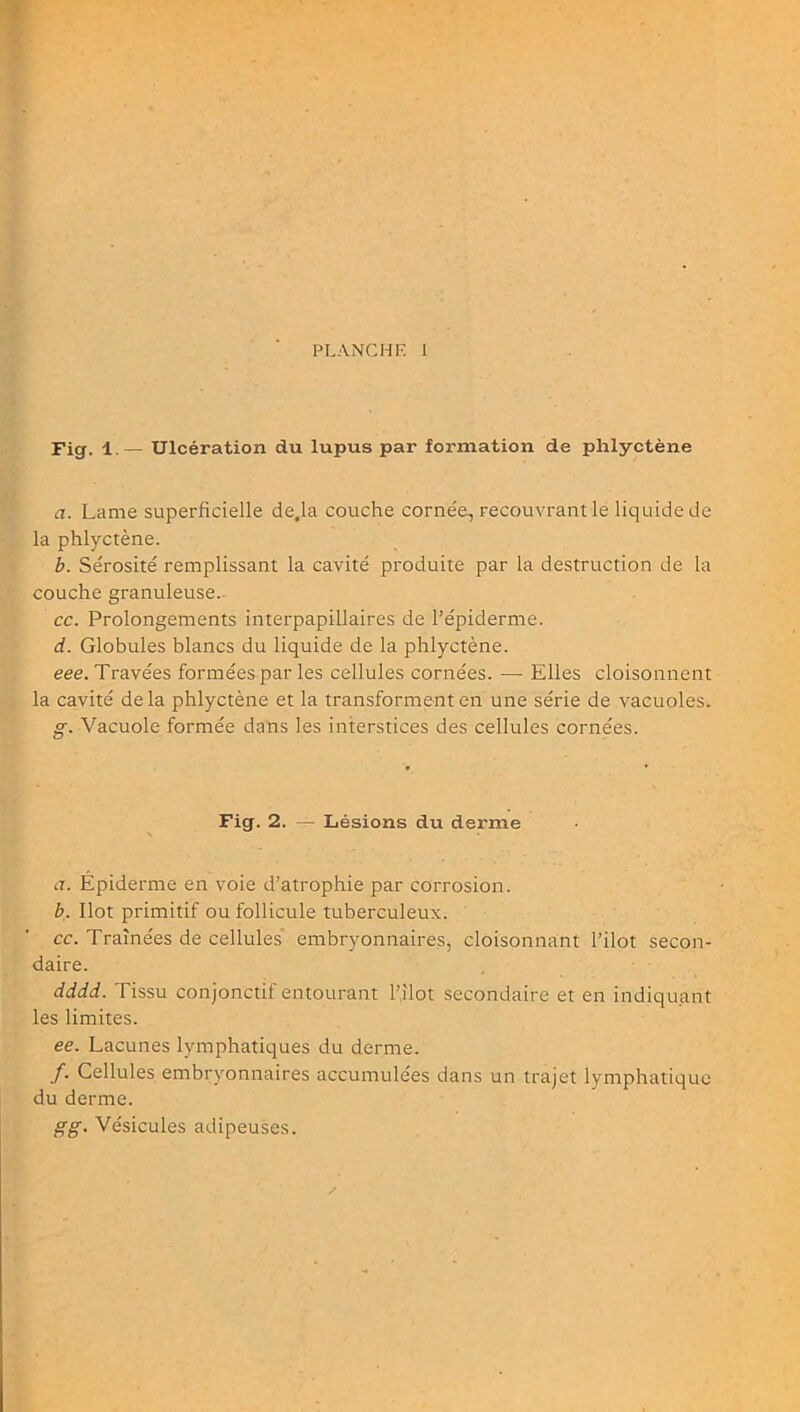 Fig. 1.— Ulcération du lupus par formation de phlyctène a. Lame superficielle de.la couche cornée, recouvrant le liquide de la phlyctène. b. Sérosité remplissant la cavité produite par la destruction de la couche granuleuse. cc. Prolongements interpapillaires de l’épiderme. d. Globules blancs du liquide de la phlyctène. eee. Travées formées par les cellules cornées. — Elles cloisonnent la cavité delà phlyctène et la transforment en une série de vacuoles. Vacuole formée dans les interstices des cellules cornées. Fig. 2. — Lésions du derme a. Épiderme en voie d’atrophie par corrosion. b. Ilot primitif ou follicule tuberculeux. cc. Traînées de cellules' embryonnaires, cloisonnant l’ilot secon- daire. dddd. Tissu conjonctif entourant l’.îlot secondaire et en indiquant les limites. ee. Lacunes lymphatiques du derme. /. Cellules embryonnaires accumulées dans un trajet lymphatique du derme. gg. Vésicules adipeuses.