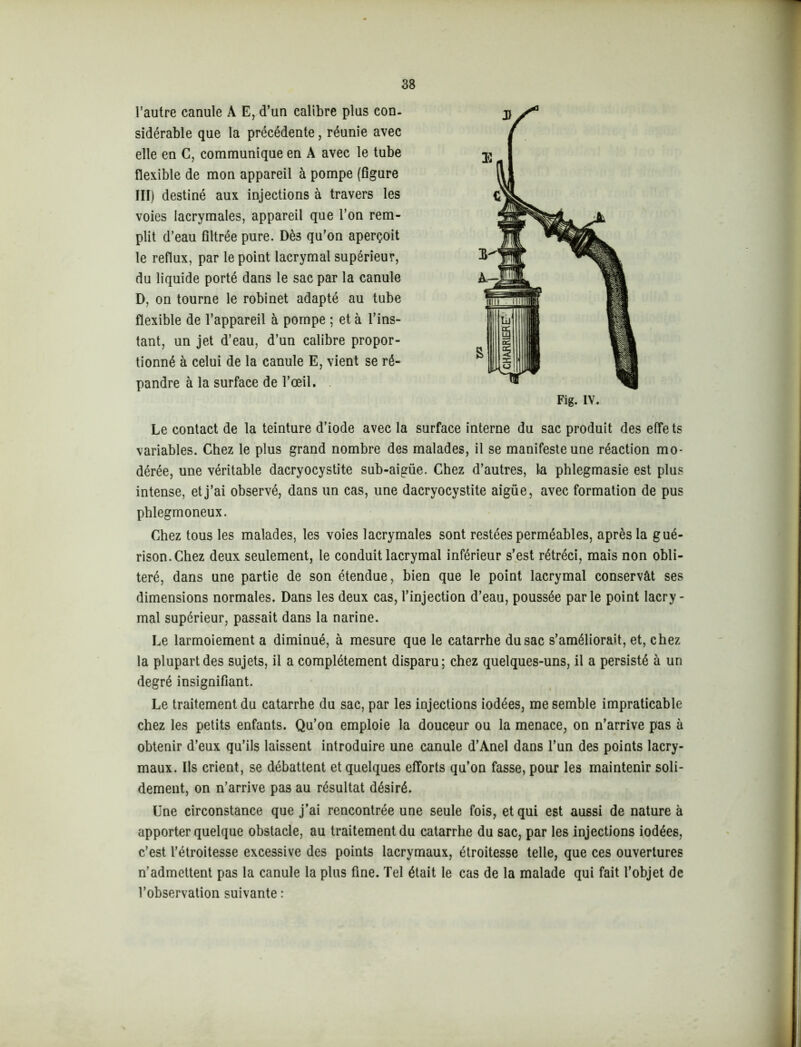 l’autre canule A E, d’un calibre plus con- sidérable que la précédente, réunie avec elle en C, communique en A avec le tube flexible de mon appareil à pompe (figure III) destiné aux injections à travers les voies lacrymales, appareil que l’on rem- plit d’eau filtrée pure. Dès qu’on aperçoit le reflux, par le point lacrymal supérieur, du liquide porté dans le sac par la canule D, on tourne le robinet adapté au tube flexible de l’appareil à pompe ; et à l’ins- tant, un jet d’eau, d’un calibre propor- tionné à celui de la canule E, vient se ré- pandre à la surface de l’œil. Le contact de la teinture d’iode avec la surface interne du sac produit des effets variables. Chez le plus grand nombre des malades, il se manifeste une réaction mo- dérée, une véritable dacryocystite sub-aigüe. Chez d’autres, la phlegmasie est plus intense, et j’ai observé, dans un cas, une dacryocystite aigüe, avec formation de pus phlegmoneux. Chez tous les malades, les voies lacrymales sont restées perméables, après la gué- rison. Chez deux seulement, le conduit lacrymal inférieur s’est rétréci, mais non obli- téré, dans une partie de son étendue, bien que le point lacrymal conservât ses dimensions normales. Dans les deux cas, l’injection d’eau, poussée parle point lacry- mal supérieur, passait dans la narine. Le larmoiement a diminué, à mesure que le catarrhe du sac s’améliorait, et, chez la plupart des sujets, il a complètement disparu; chez quelques-uns, il a persisté à un degré insignifiant. Le traitement du catarrhe du sac, par les injections iodées, me semble impraticable chez les petits enfants. Qu’on emploie la douceur ou la menace, on n’arrive pas à obtenir d’eux qu’ils laissent introduire une canule d’Anel dans l’un des points lacry- maux. Ils crient, se débattent et quelques efforts qu’on fasse, pour les maintenir soli- dement, on n’arrive pas au résultat désiré. Une circonstance que j’ai rencontrée une seule fois, et qui est aussi de nature à apporter quelque obstacle, au traitement du catarrhe du sac, par les injections iodées, c’est l’étroitesse excessive des points lacrymaux, étroitesse telle, que ces ouvertures n’admettent pas la canule la plus fine. Tel était le cas de la malade qui fait l’objet de l’observation suivante :