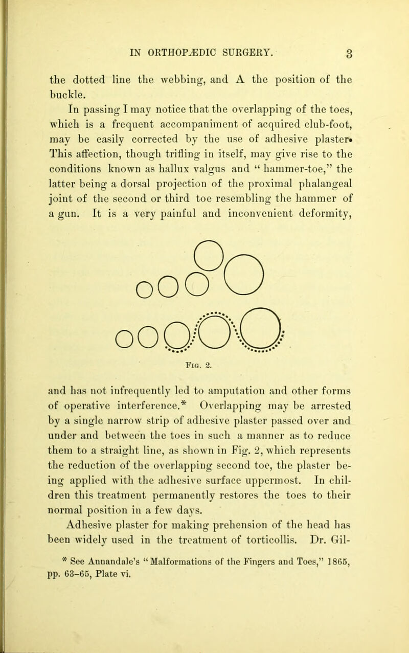 the dotted line the webbing, and A the position of the buckle. In passing I may notice that the overlapping of the toes, which is a frequent accompaniment of acquired club-foot, may be easily corrected by the use of adhesive plaster* This affection, though trifling in itself, may give rise to the conditions known as hallux valgus and “ hammer-toe,” the latter being a dorsal projection of the proximal phalangeal joint of the second or third toe resembling the hammer of a gun. It is a very painful and inconvenient deformity, and has not infrequently led to amputation and other forms of operative interference.* Overlapping may be arrested by a single narrow strip of adhesive plaster passed over and under and between the toes in such a manner as to reduce them to a straight line, as shown in Fig. 2, which represents the reduction of the overlapping second toe, the plaster be- ing applied with the adhesive surface uppermost. In chil- dren this treatment permanently restores the toes to their normal position in a few days. Adhesive plaster for making prehension of the head has been widely used in the treatment of torticollis. Dr. Gil- * See Annandale’s “ Malformations of the Fingers and Toes,” ] 866, pp. 63-66, Plate vi.