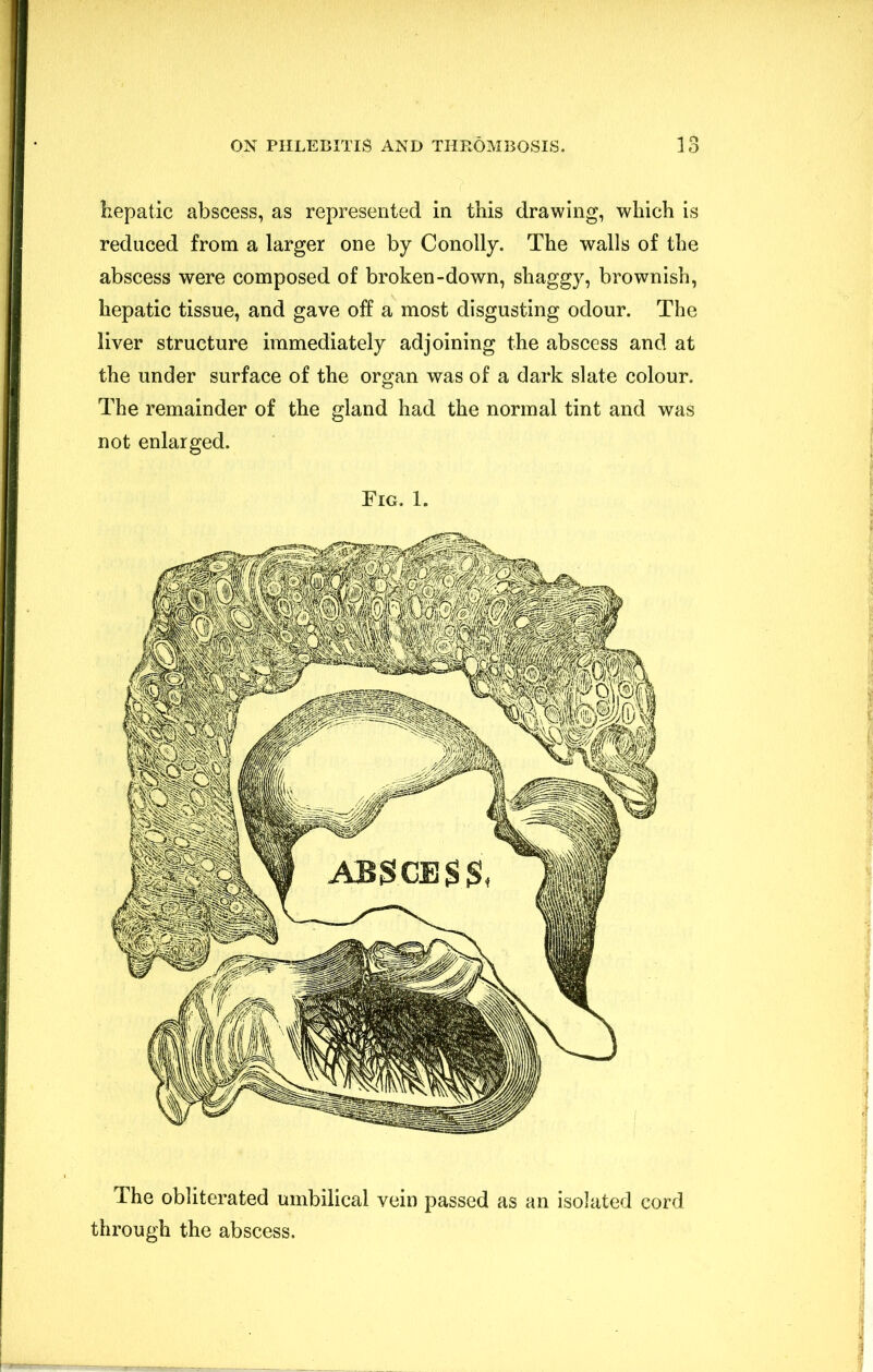hepatic abscess, as represented in this drawing, which is reduced from a larger one by Conolly. The walls of the abscess were composed of broken-down, shaggy, brownish, hepatic tissue, and gave off a most disgusting odour. The liver structure immediately adjoining the abscess and at the under surface of the organ was of a dark slate colour. The remainder of the gland had the normal tint and was not enlarged. Fig. 1. The obliterated umbilical vein passed as an isolated cord through the abscess.