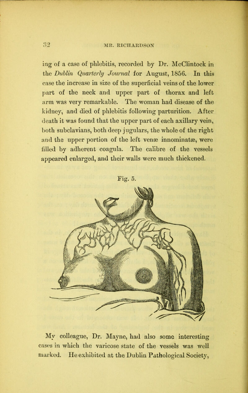 ing of a case of phlebitis, recorded by Dr. McClintock in the Dublin Quarte7'ly Journal for August, 1856. In this case the increase in size of the superficial veins of the lower part of the neck and upper part of thorax and left arm was very remarkable. The woman had disease of the kidney, and died of phlebitis following parturition. After death it was found that the upper part of each axillary vein, both subclavians, both deep jugulars, the whole of the right and the upper portion of the left venae innominatae, were filled by adherent coagula. The calibre of the vessels appeared enlarged, and their walls were much thickened. Fig. 5. My colleague. Dr. Mayne, had also some interesting cases in which the varicose state of the vessels was well marked. He exhibited at the Dublin Pathological Society,