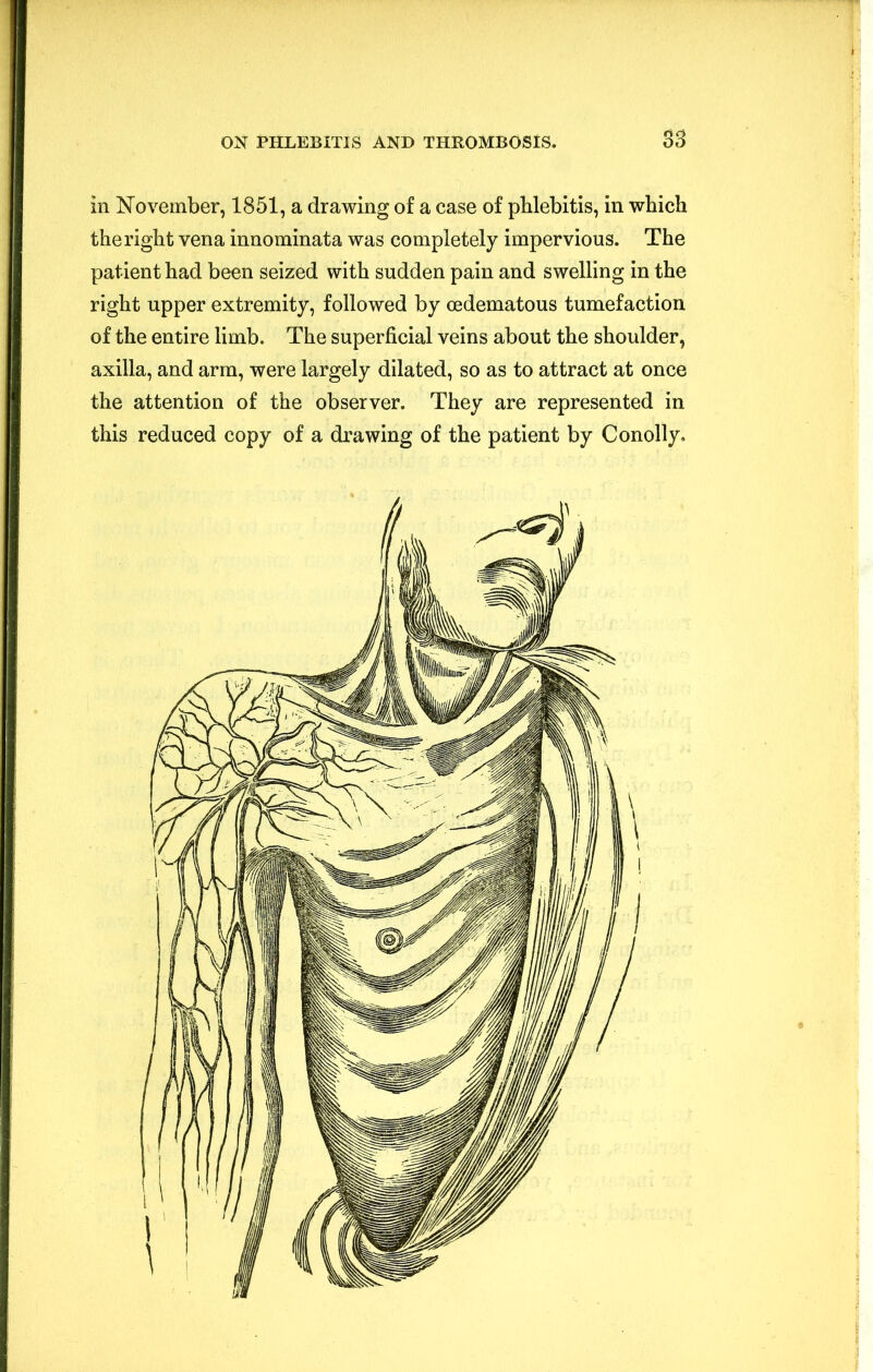 S3 in November, 1851, a drawing of a case of phlebitis, in which the right vena innominata was completely impervious. The patient had been seized with sudden pain and swelling in the right upper extremity, followed by oedematous tumefaction of the entire limb. The superficial veins about the shoulder, axilla, and arm, were largely dilated, so as to attract at once the attention of the observer. They are represented in this reduced copy of a drawing of the patient by Conolly.